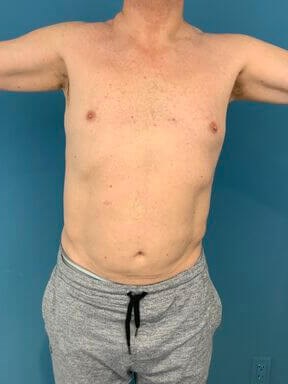 Liposuction of a Male Abdomen and Flanks with VASER — before, view 2