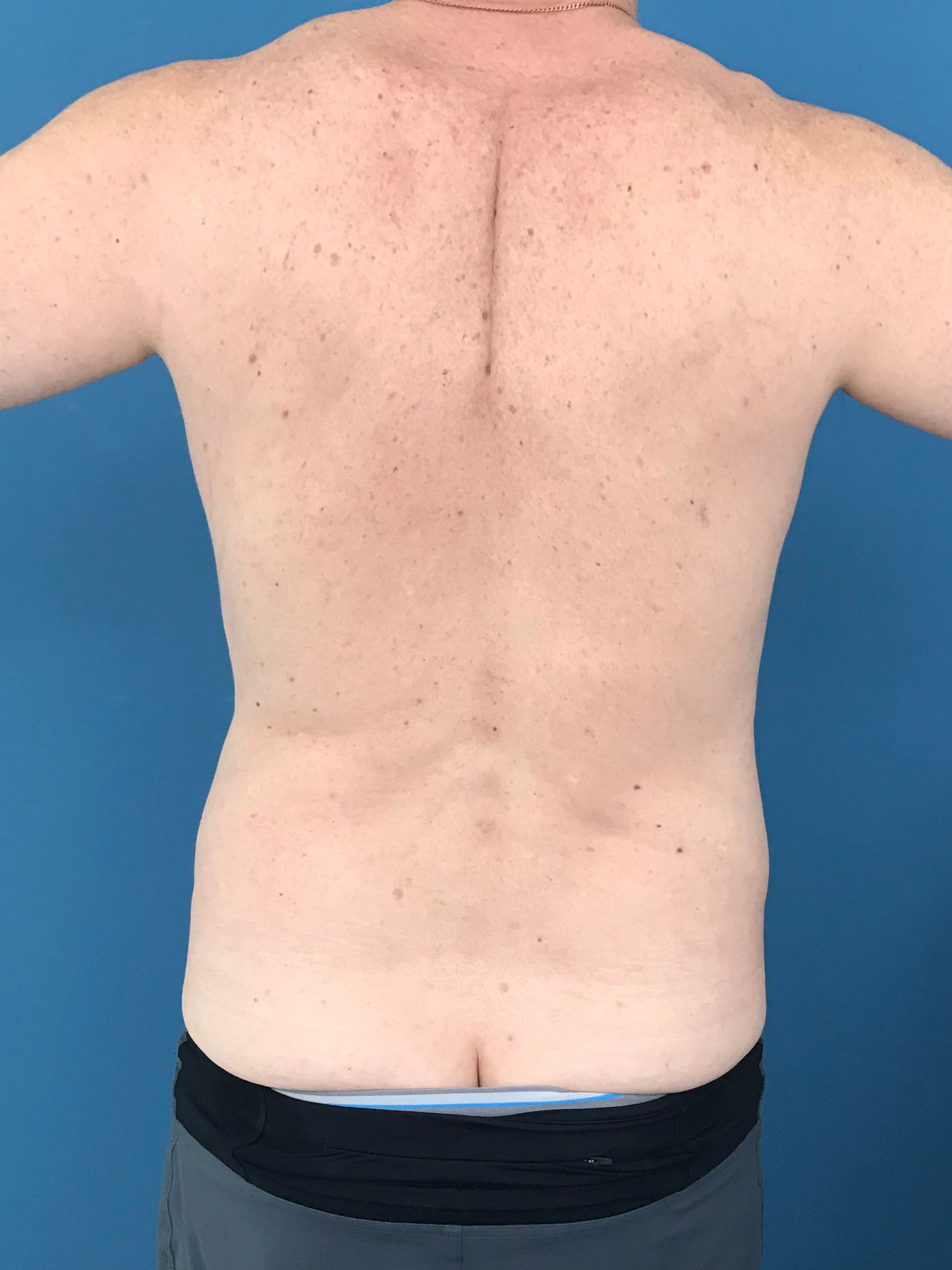 Liposuction of a Male Abdomen and Flanks with VASER — before, view 3