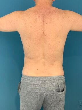 Liposuction of a Male Abdomen and Flanks with VASER — before, view 4