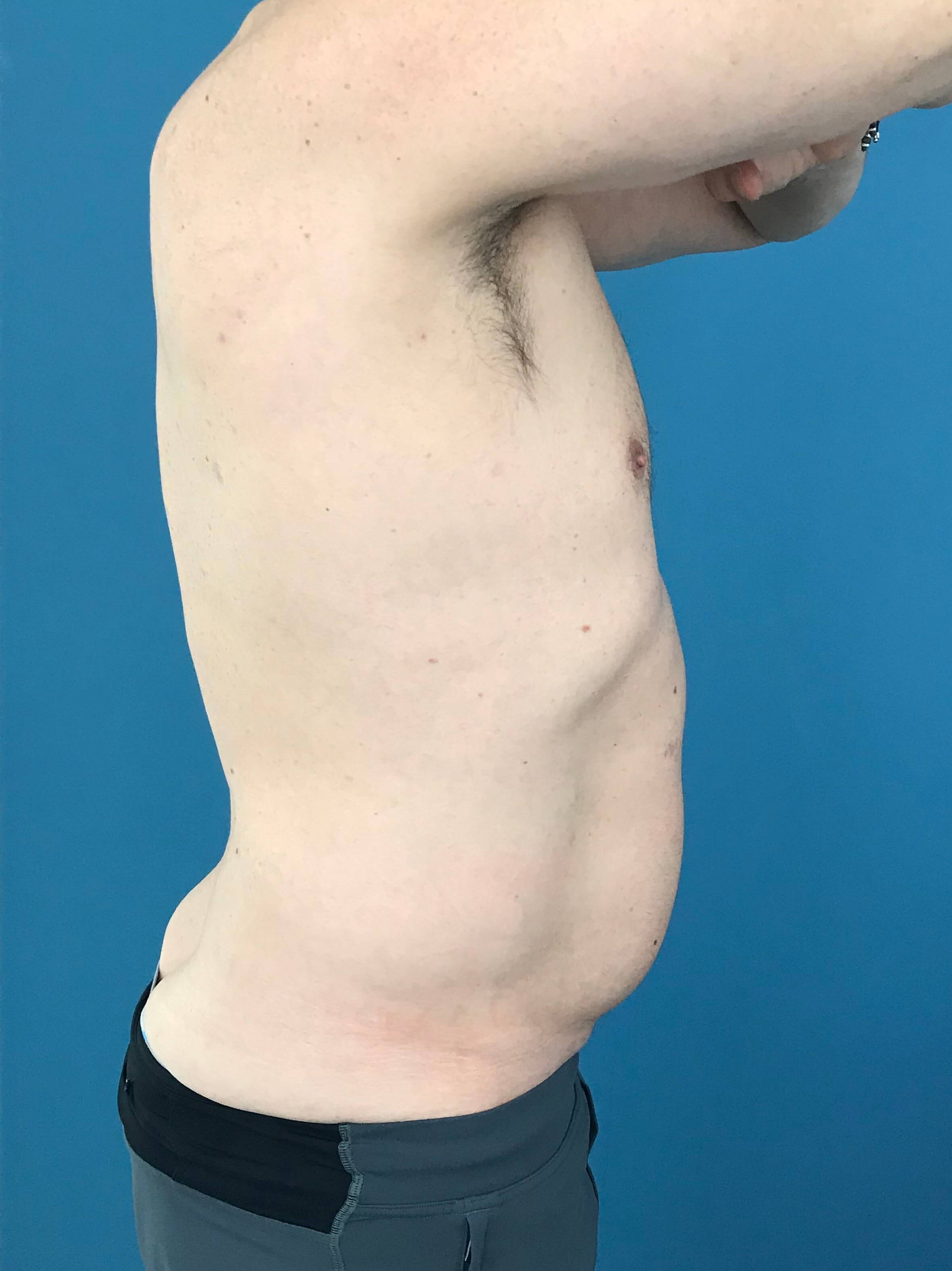 Liposuction of a Male Abdomen and Flanks with VASER