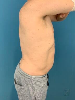 Liposuction of a Male Abdomen and Flanks with VASER — after, view 2