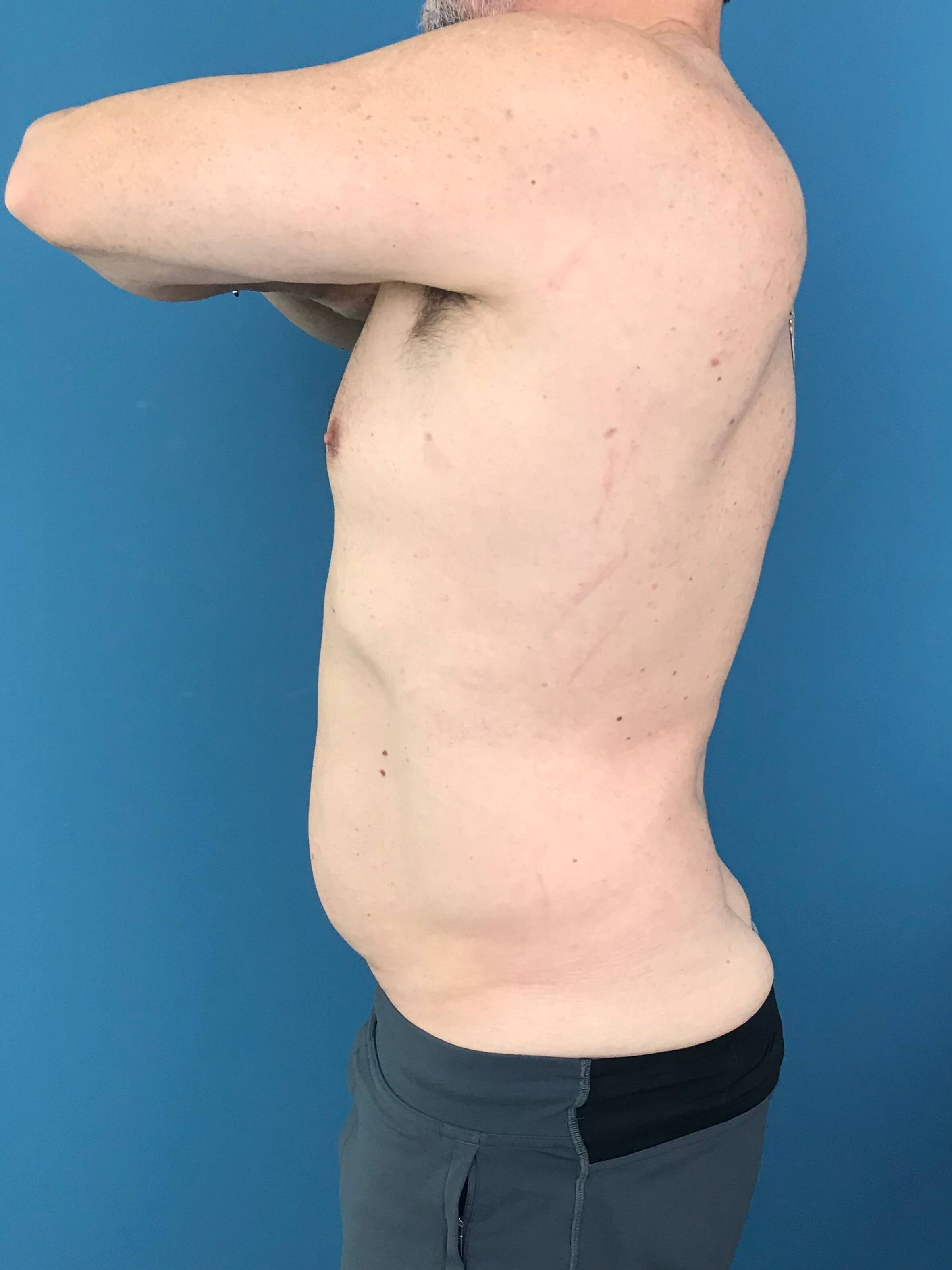 Liposuction of a Male Abdomen and Flanks with VASER — after, view 3