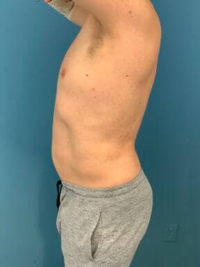 Liposuction of a Male Abdomen and Flanks with VASER — after, view 4