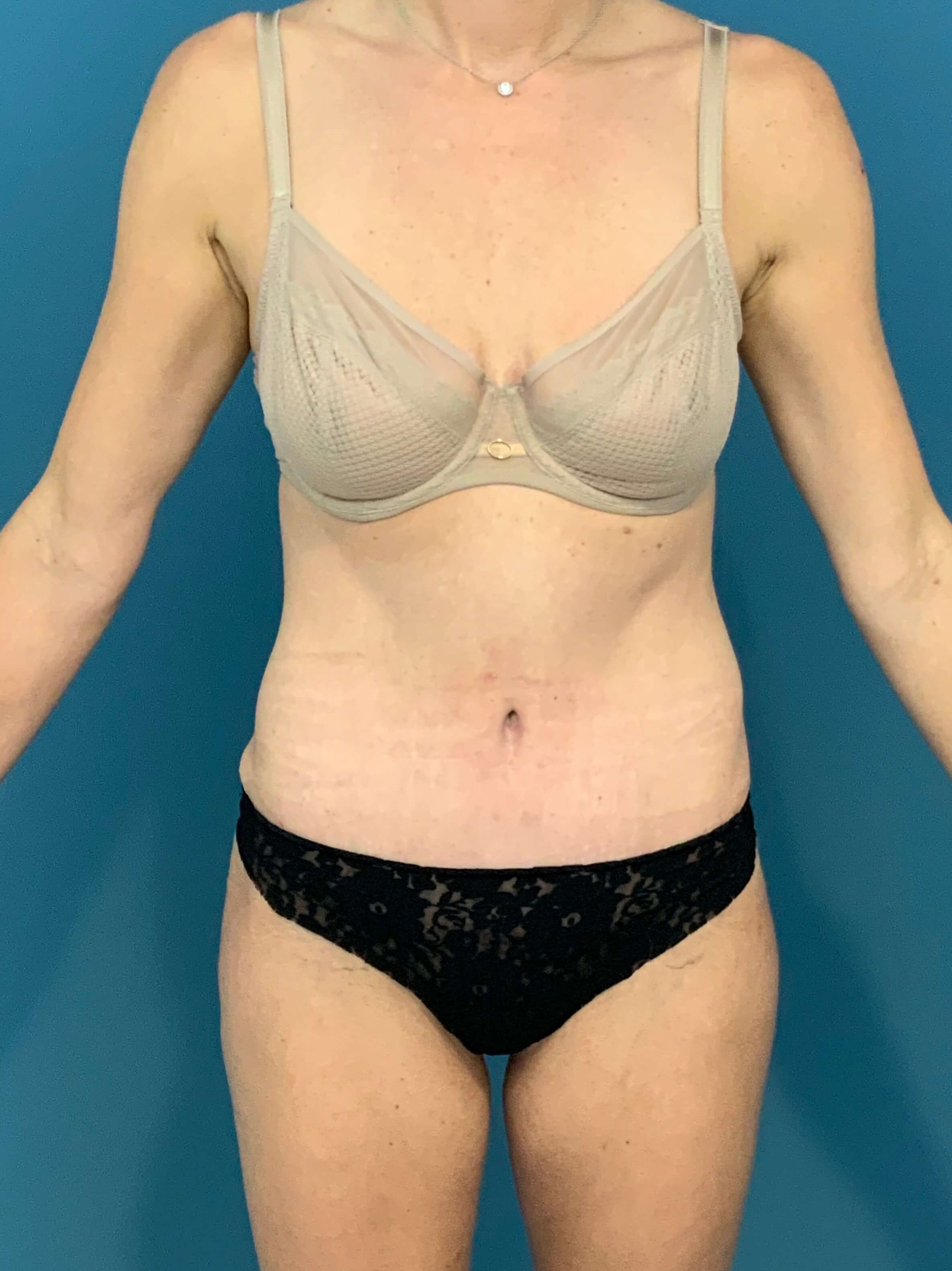 Tummy Tuck and Liposuction of the Flanks. — before, view 2