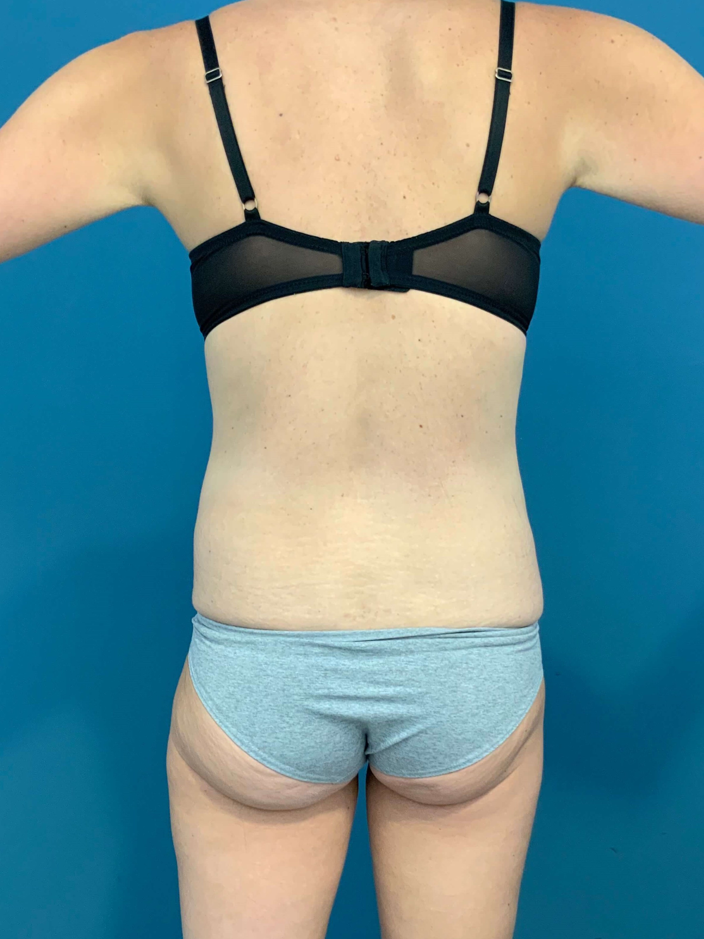 Tummy Tuck and Liposuction of the Flanks. — before, view 3