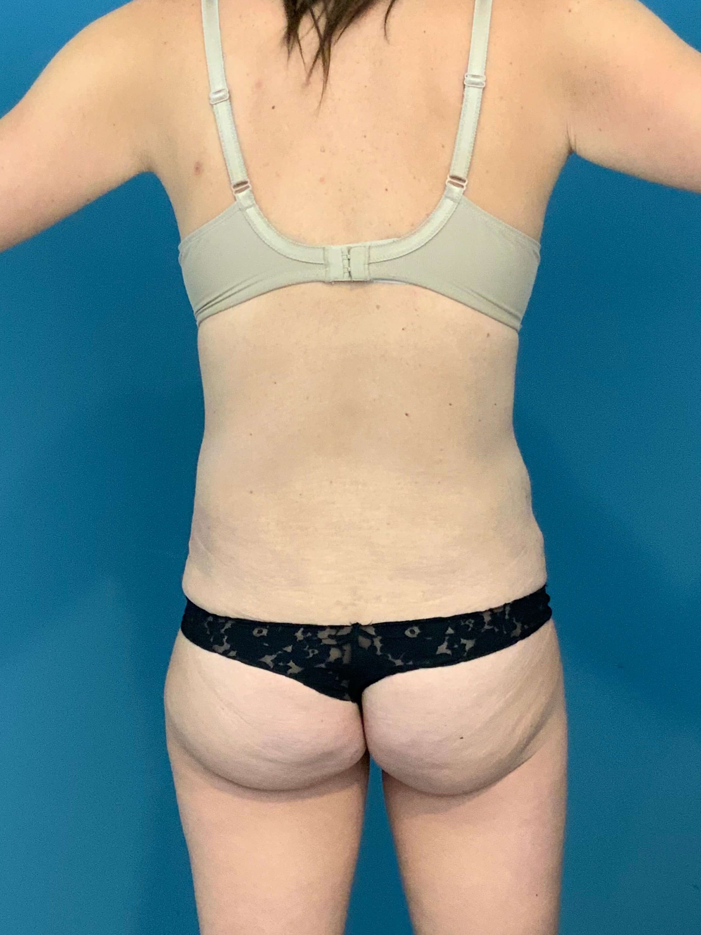 Tummy Tuck and Liposuction of the Flanks. — before, view 4