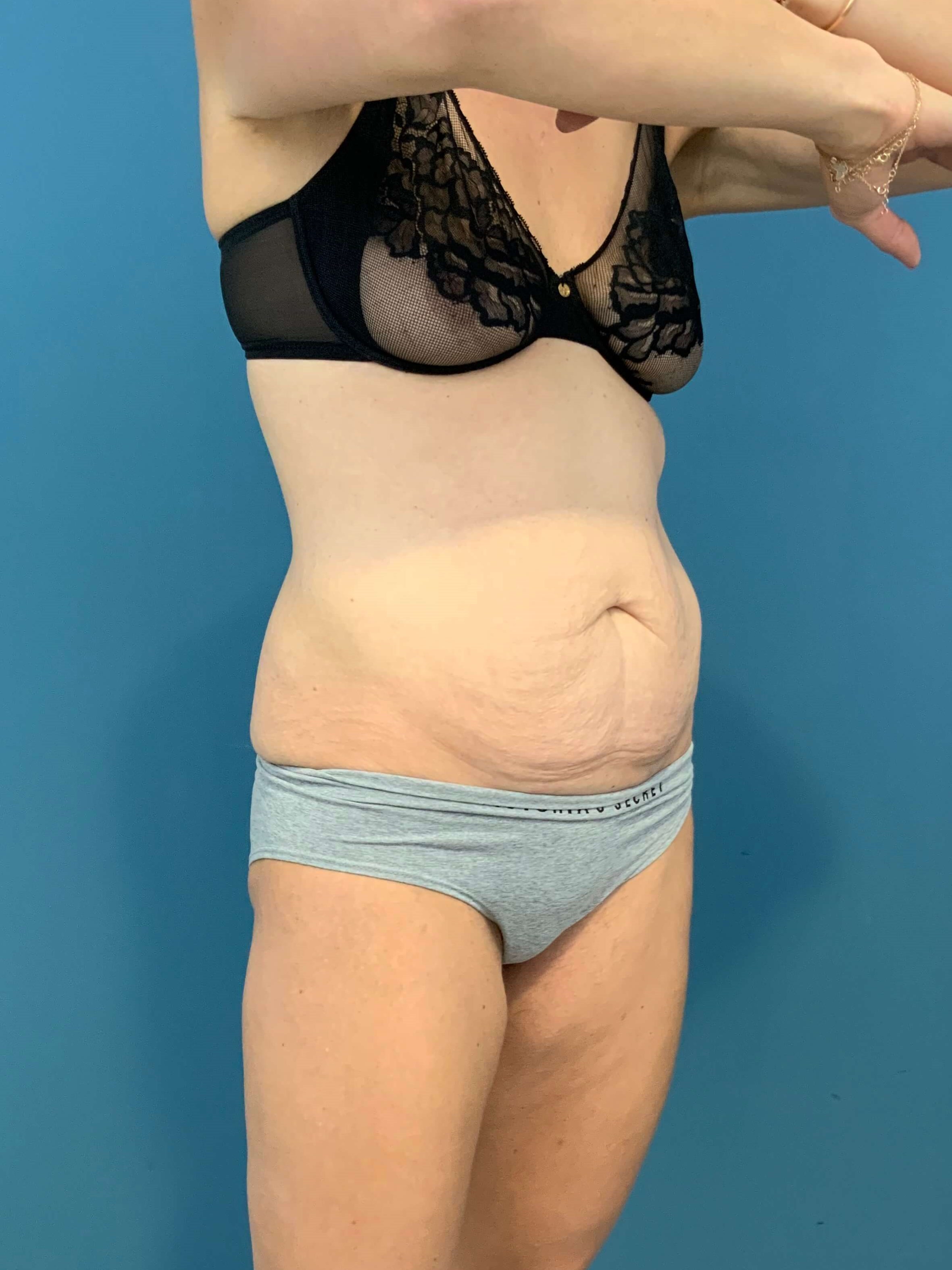 Tummy Tuck and Liposuction of the Flanks. — before, view 5