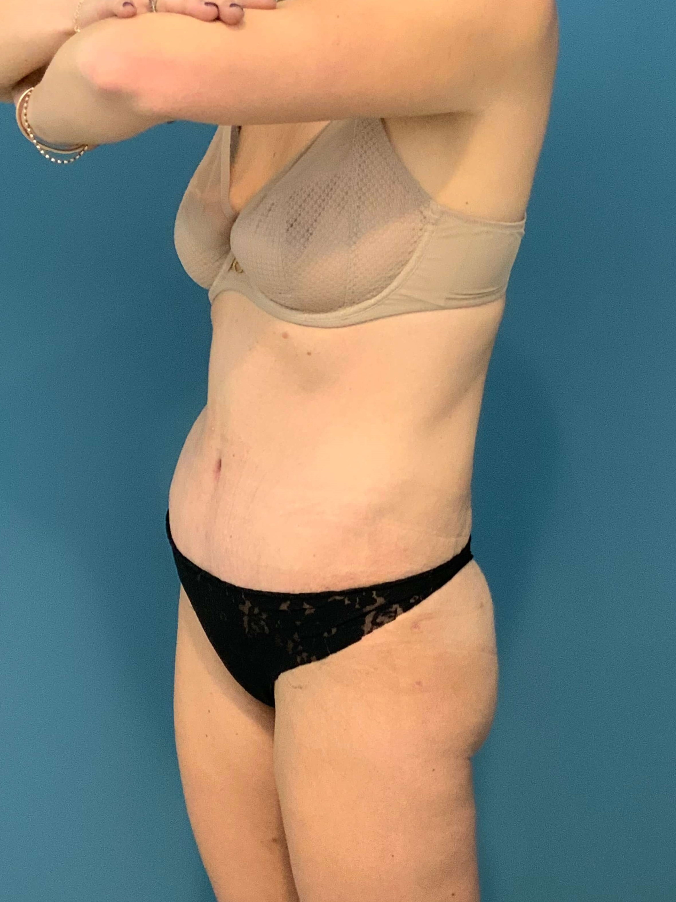 Tummy Tuck and Liposuction of the Flanks. — after, view 2
