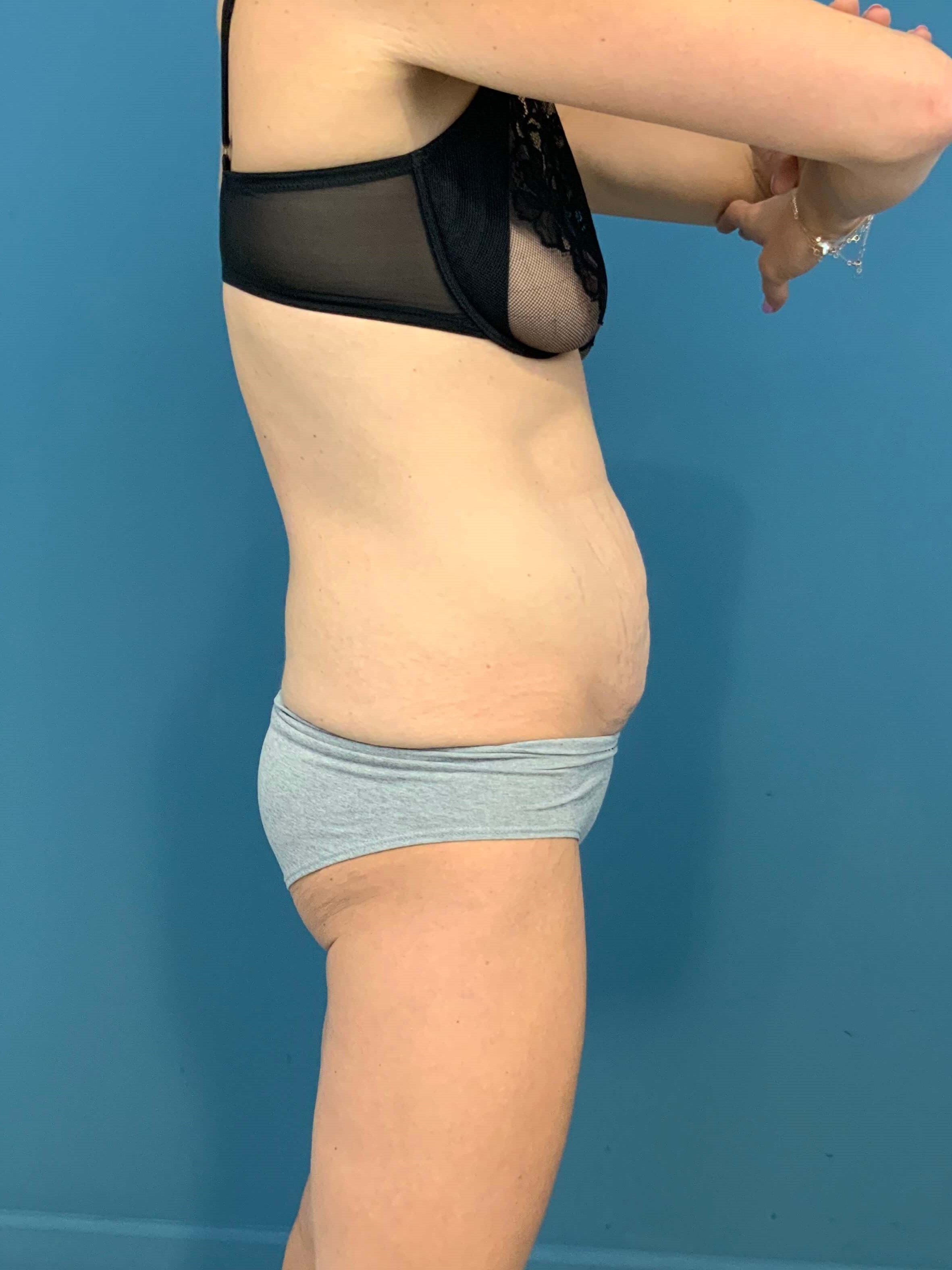 Tummy Tuck and Liposuction of the Flanks. — after, view 3