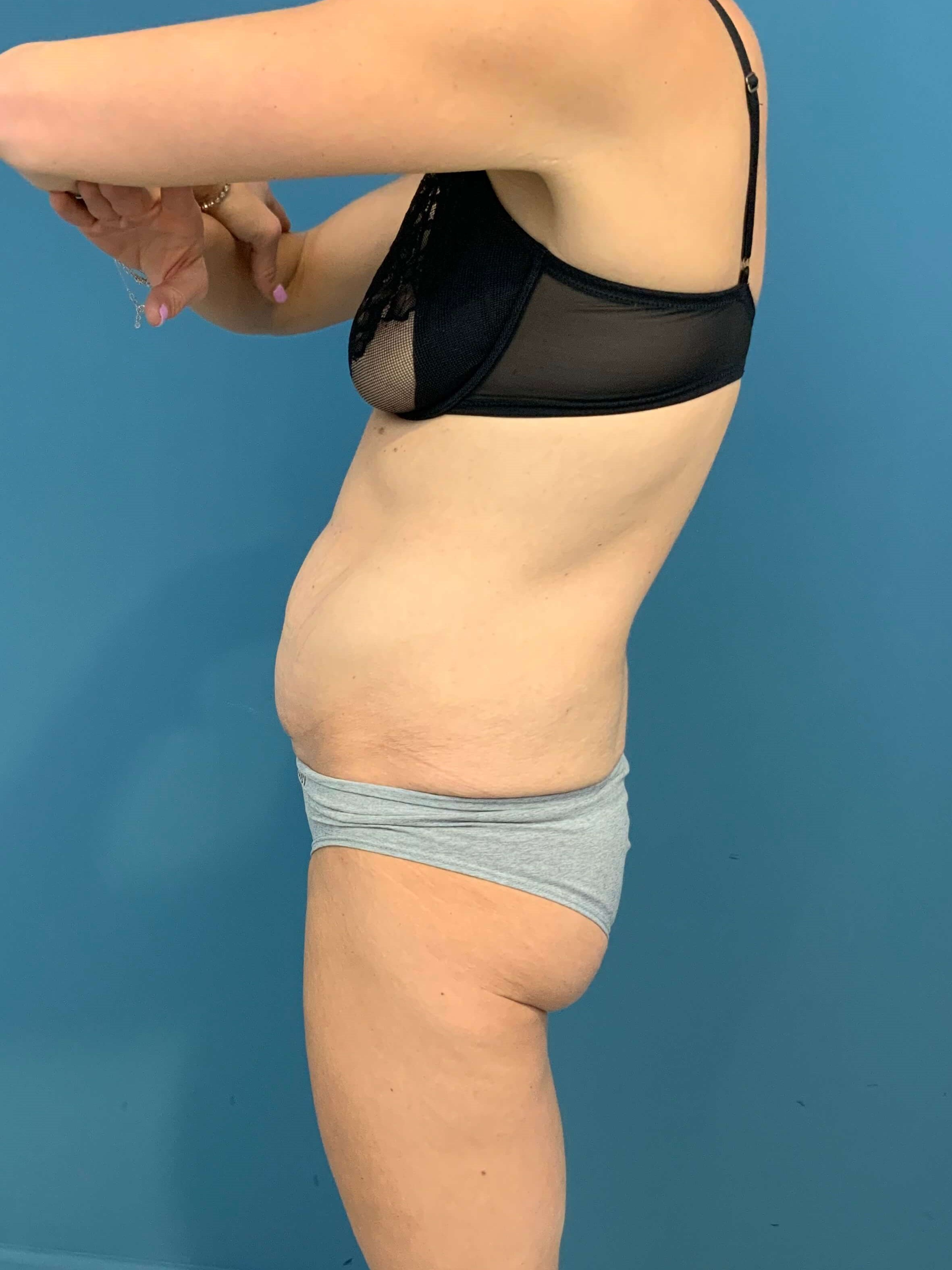 Tummy Tuck and Liposuction of the Flanks. — after, view 5