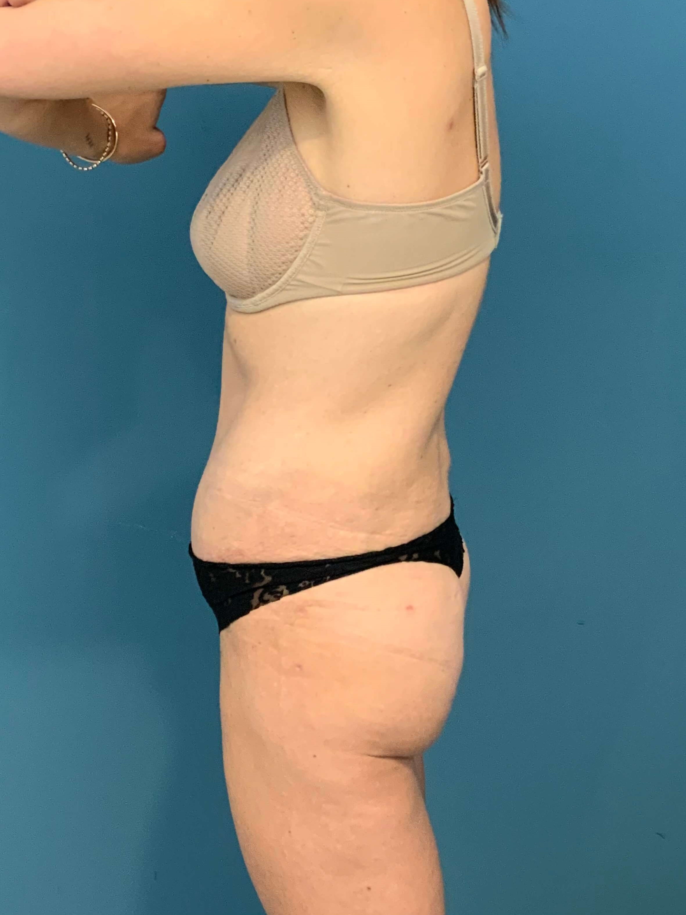 Tummy Tuck and Liposuction of the Flanks. — after, view 4