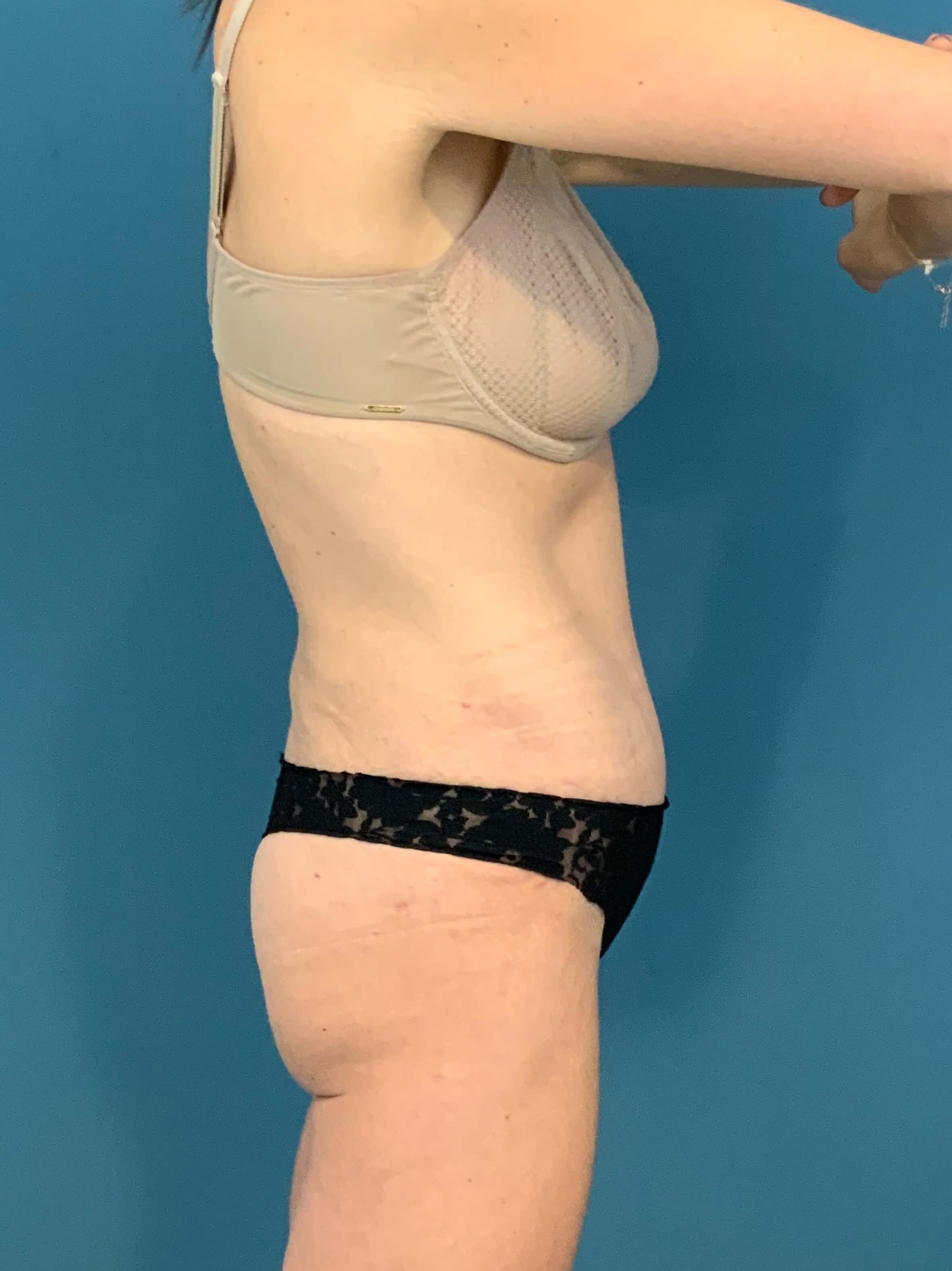 Tummy Tuck and Liposuction of the Flanks. — after, view 6