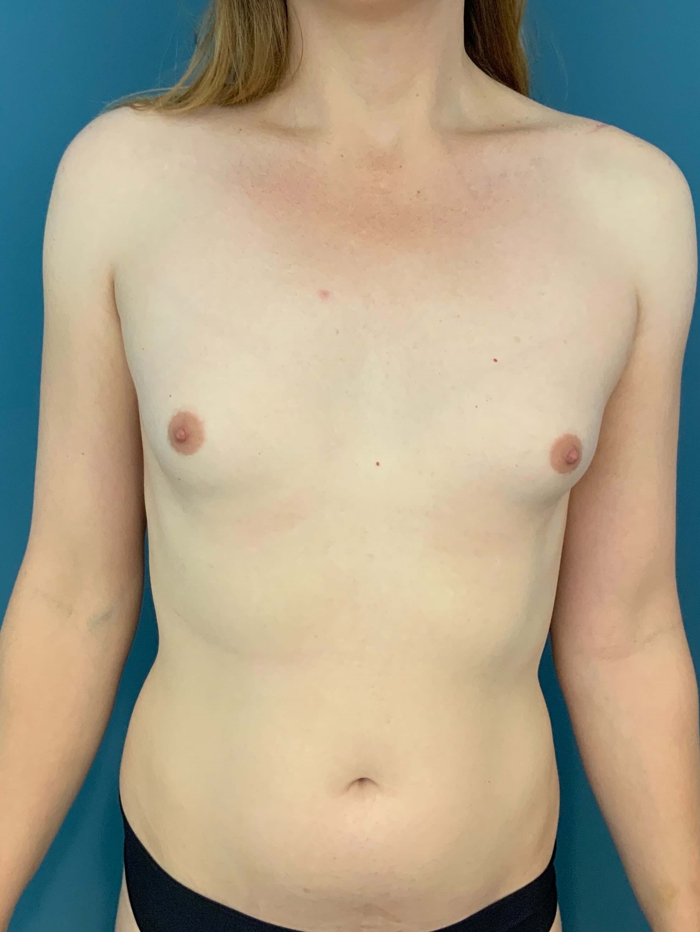 Fat Transfer to the Breasts on a Transgender Woman — before, view 1
