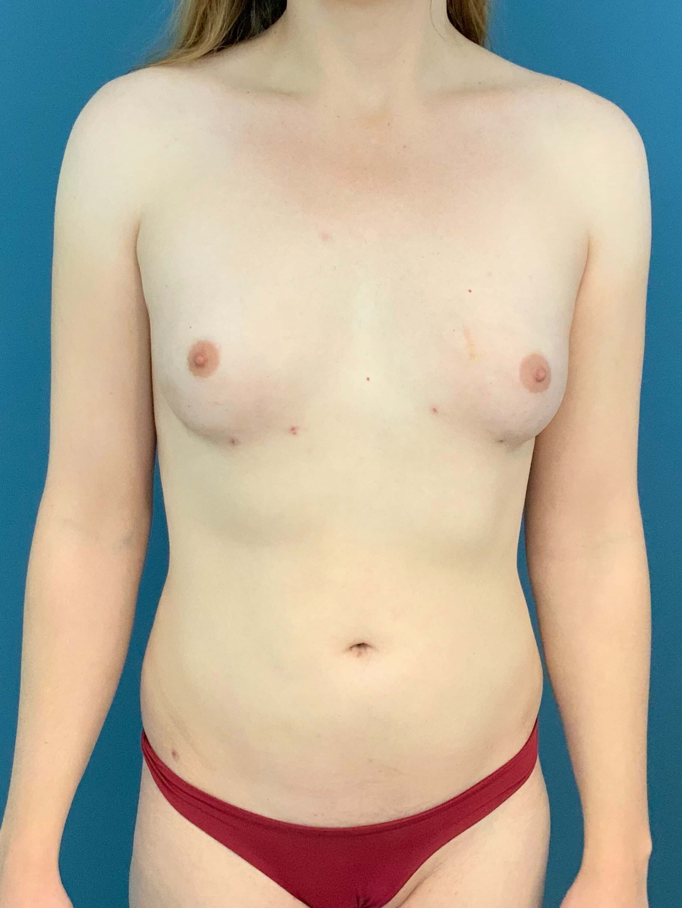 Fat Transfer to the Breasts on a Transgender Woman