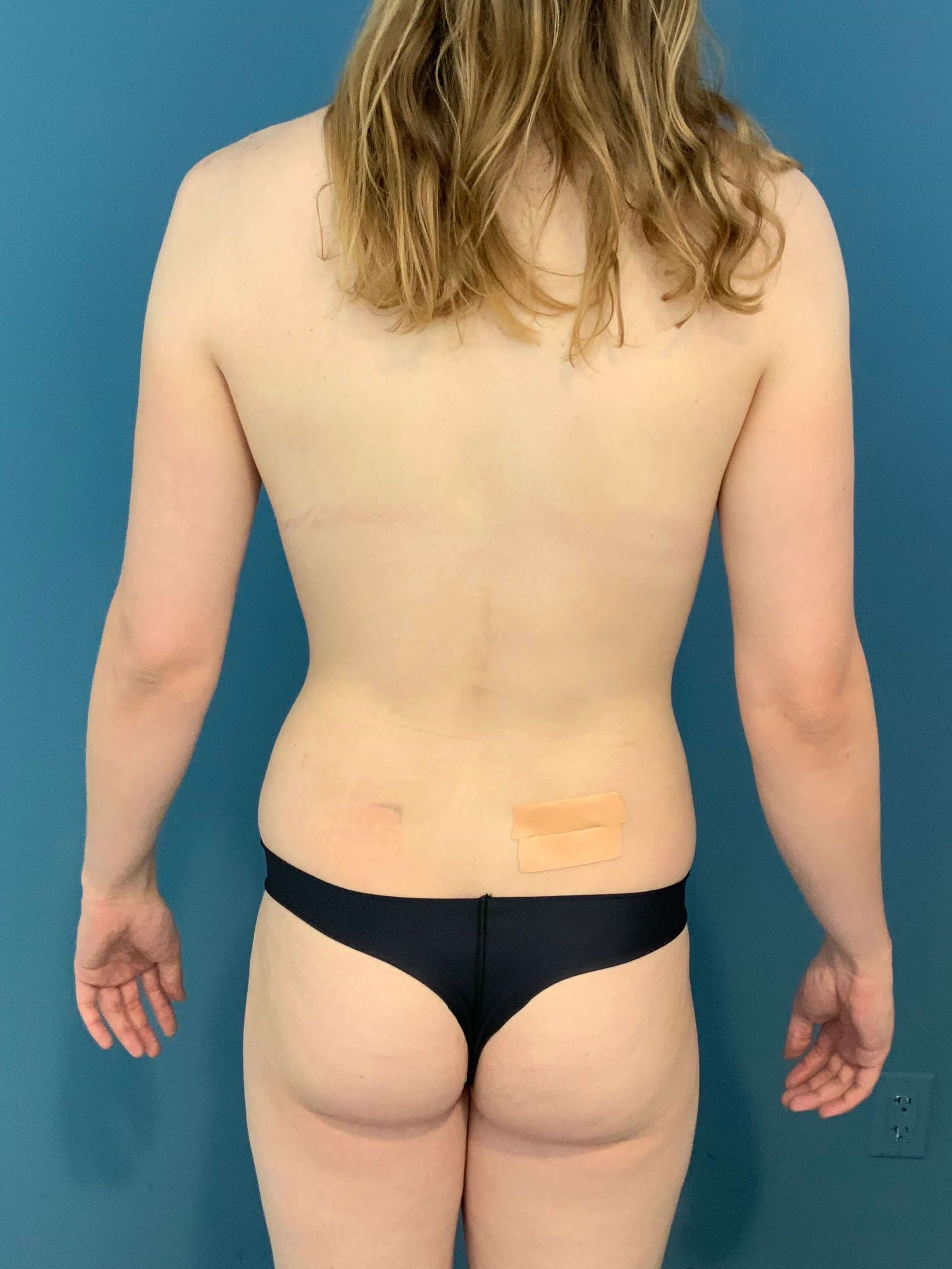 Fat Transfer to the Breasts on a Transgender Woman — before, view 2