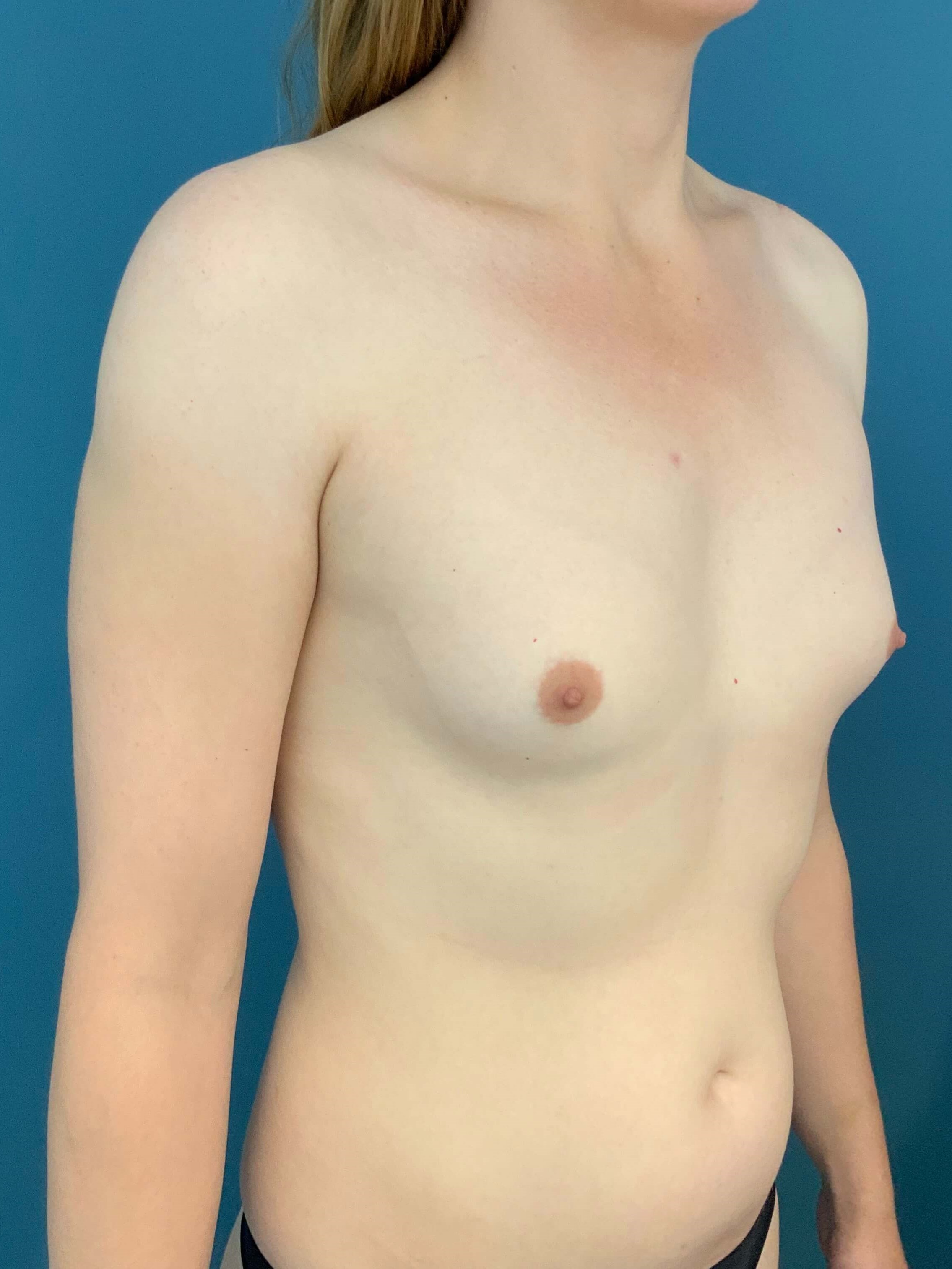 Fat Transfer to the Breasts on a Transgender Woman — before, view 3