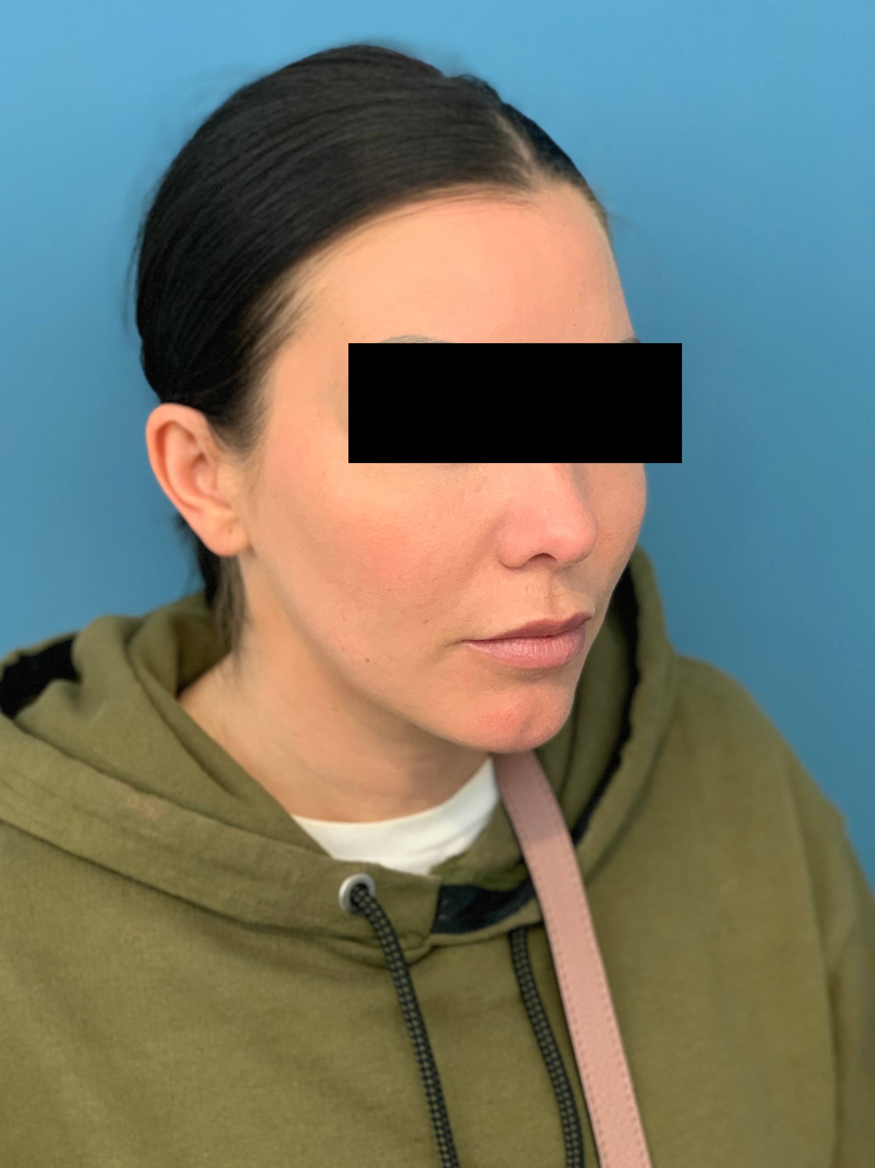 Buccal Fat Removal, after, view 1