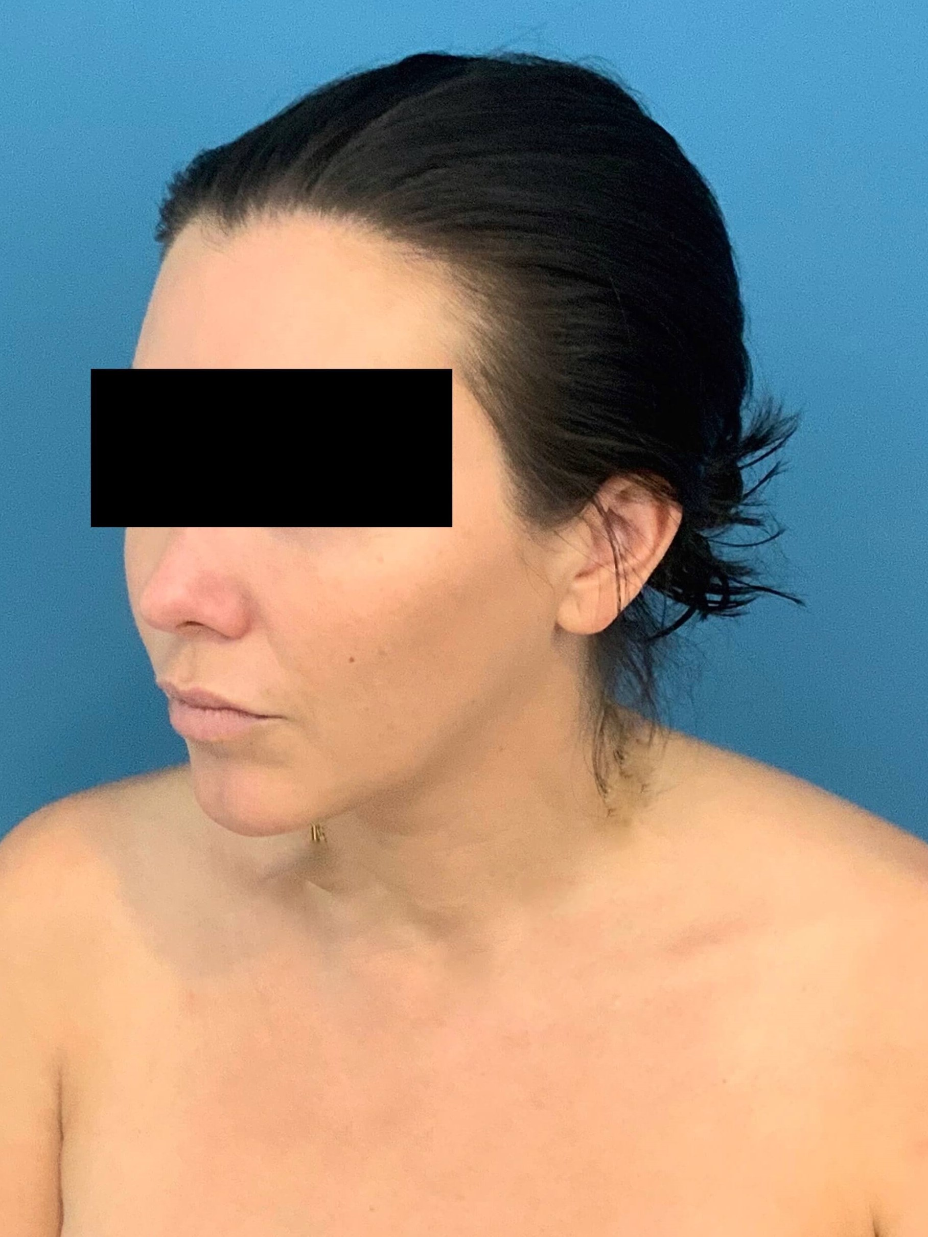 Buccal Fat Removal, before, view 2