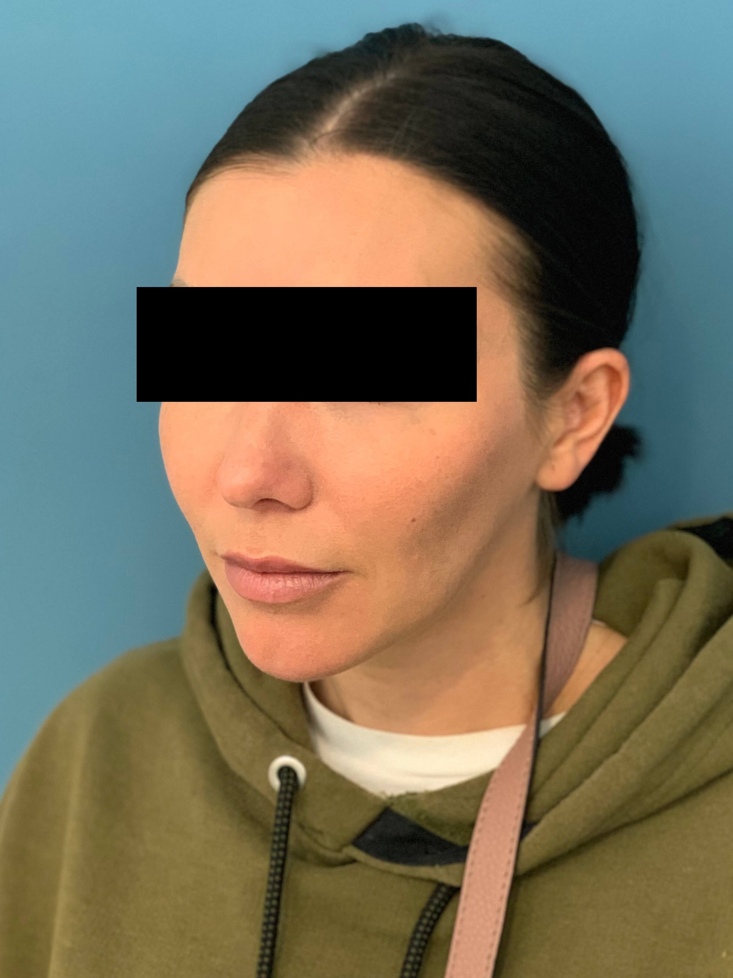 Buccal Fat Removal, after, view 2