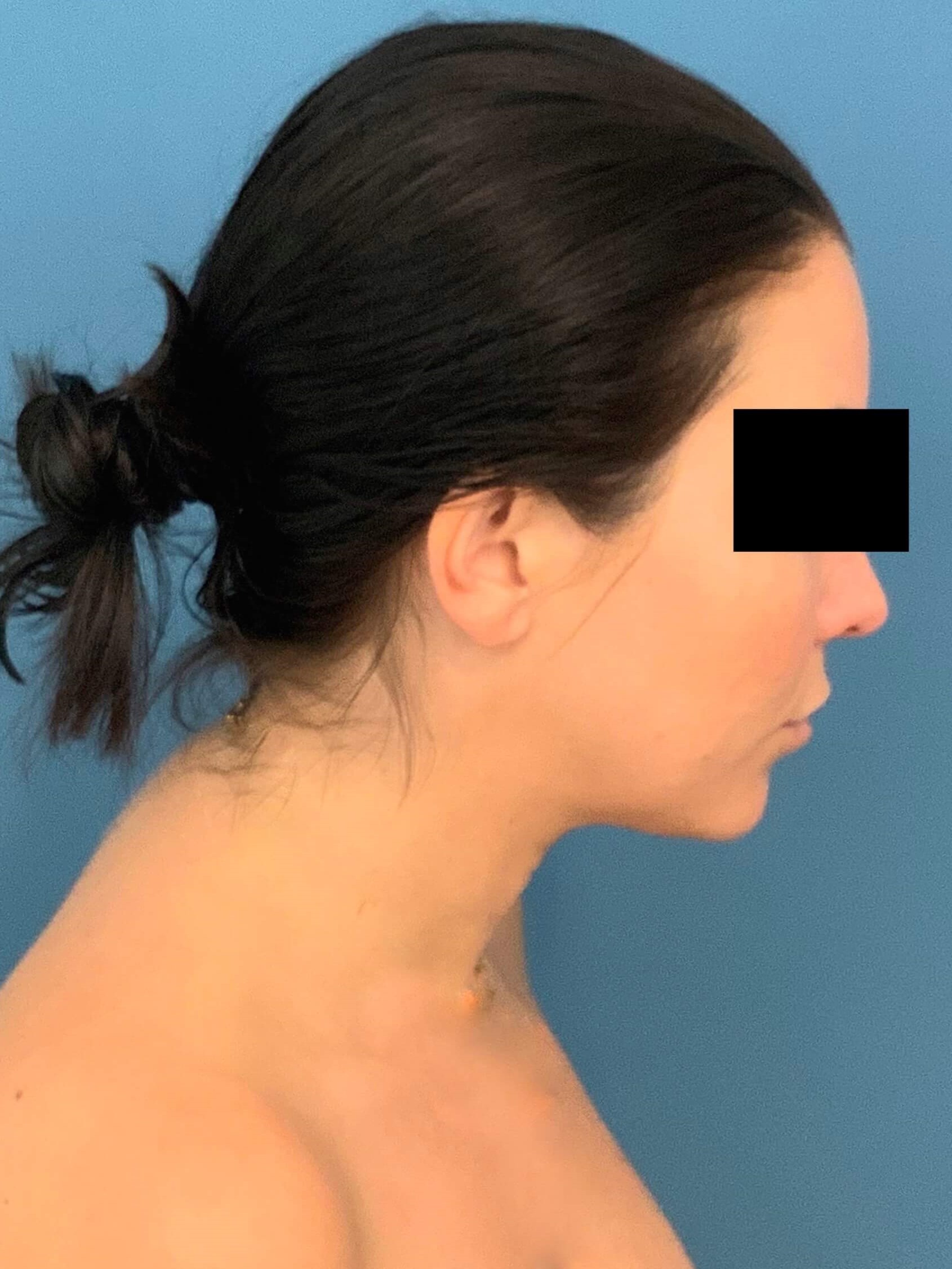 Buccal Fat Removal, before, view 3
