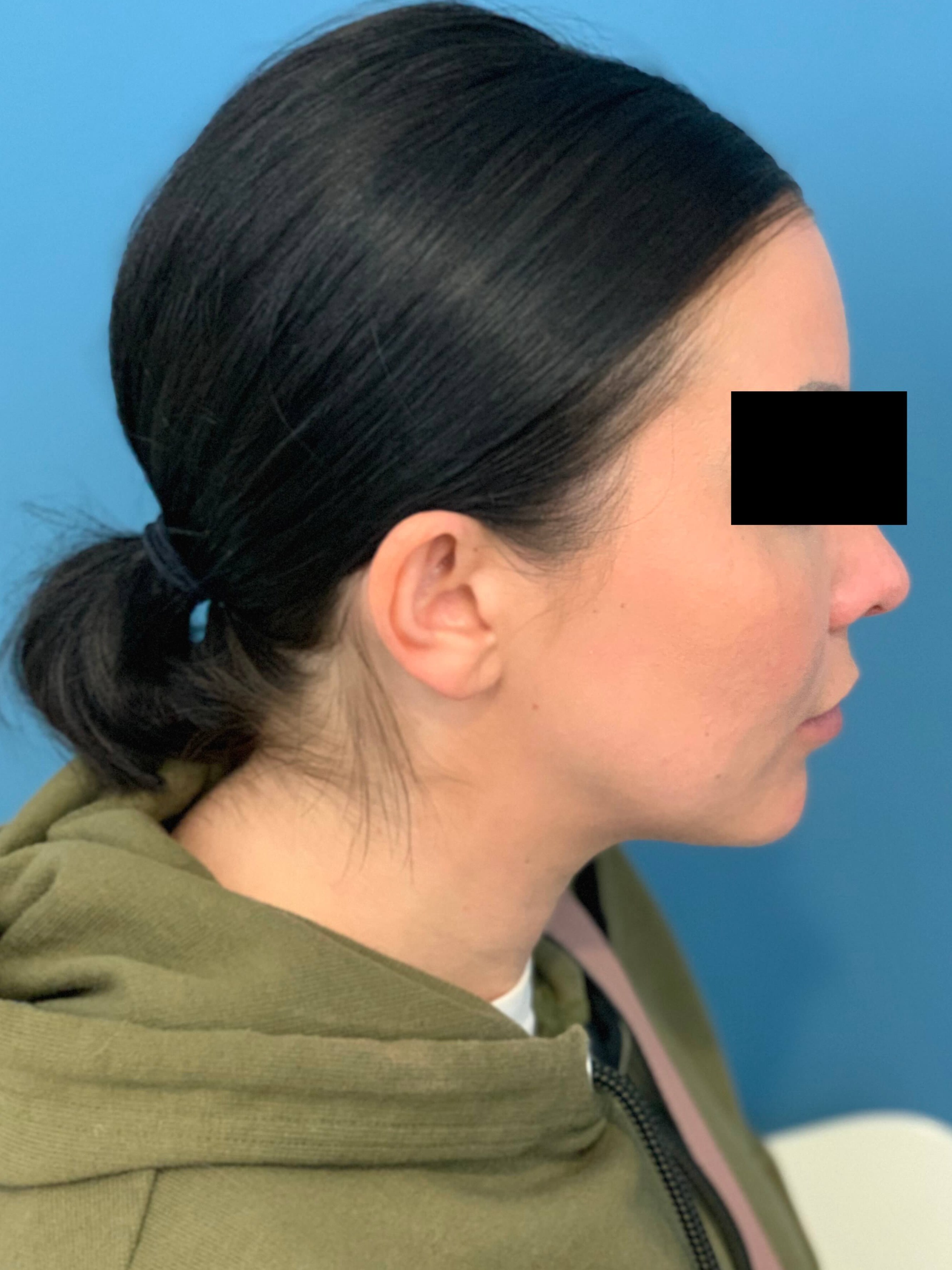 Buccal Fat Removal, after, view 3