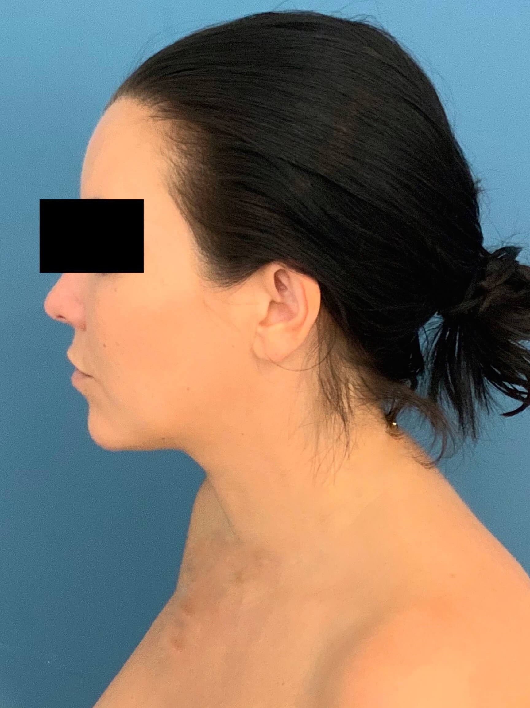 Buccal Fat Removal, before, view 4