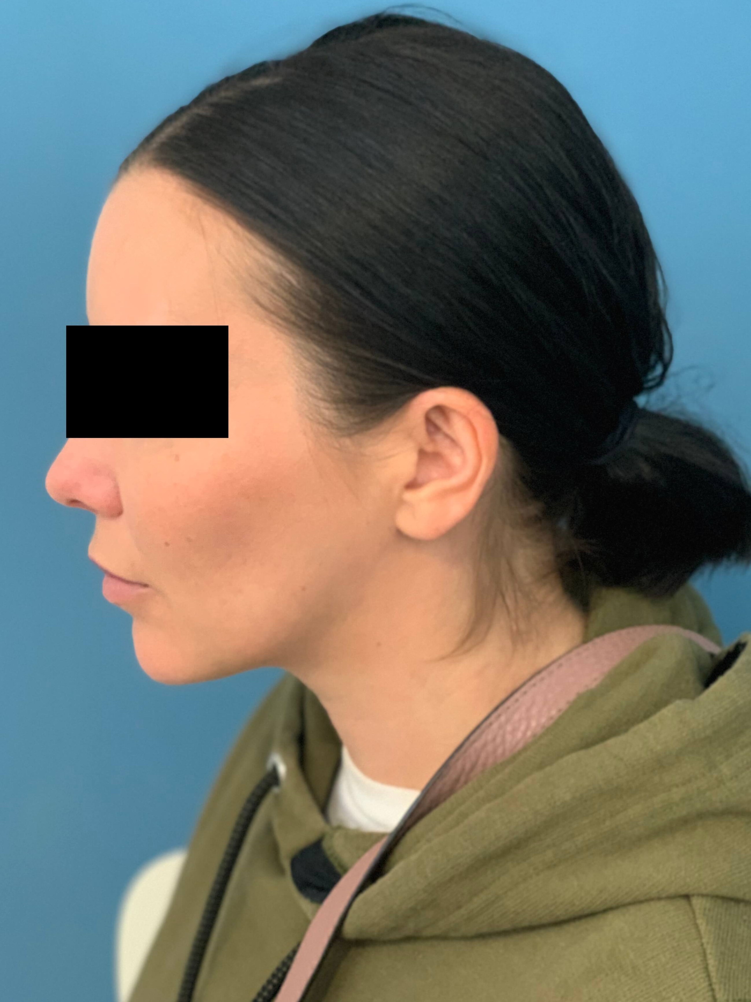 Buccal Fat Removal, after, view 4