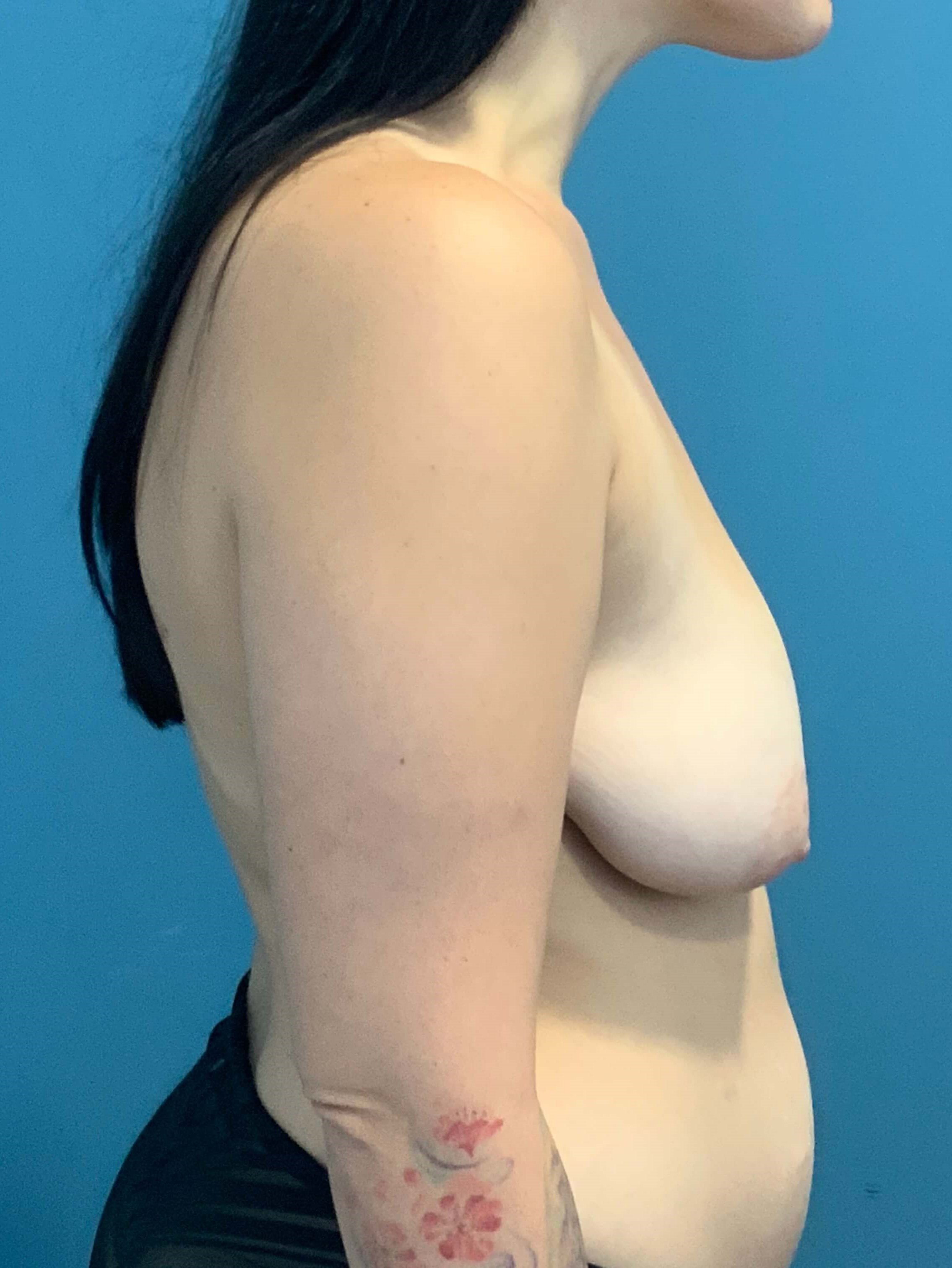 Breast Lift (Mastopexy) with Fat Grafting in Massive Weight Loss Patient — before, view 2