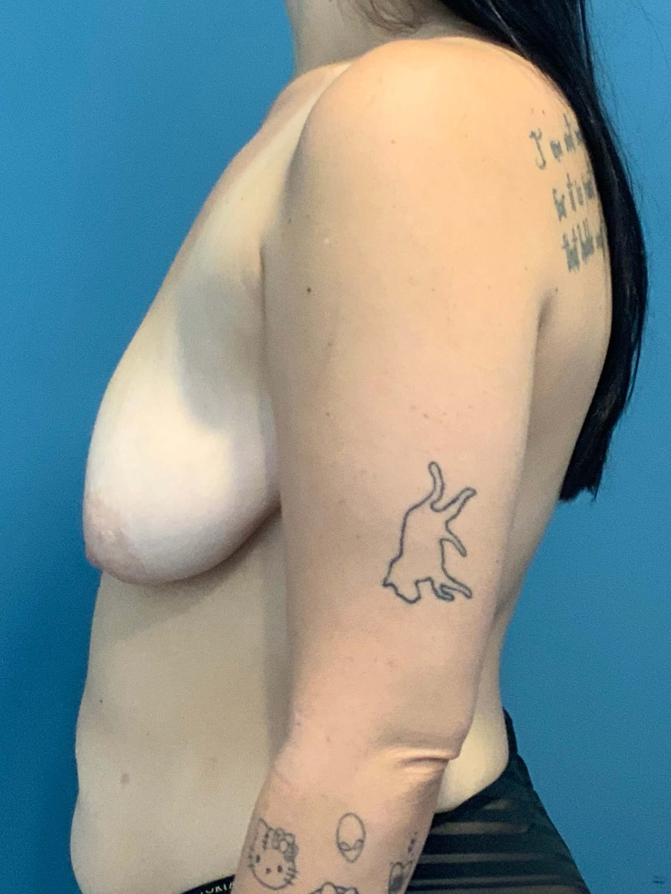 Breast Lift (Mastopexy) with Fat Grafting in Massive Weight Loss Patient — before, view 3