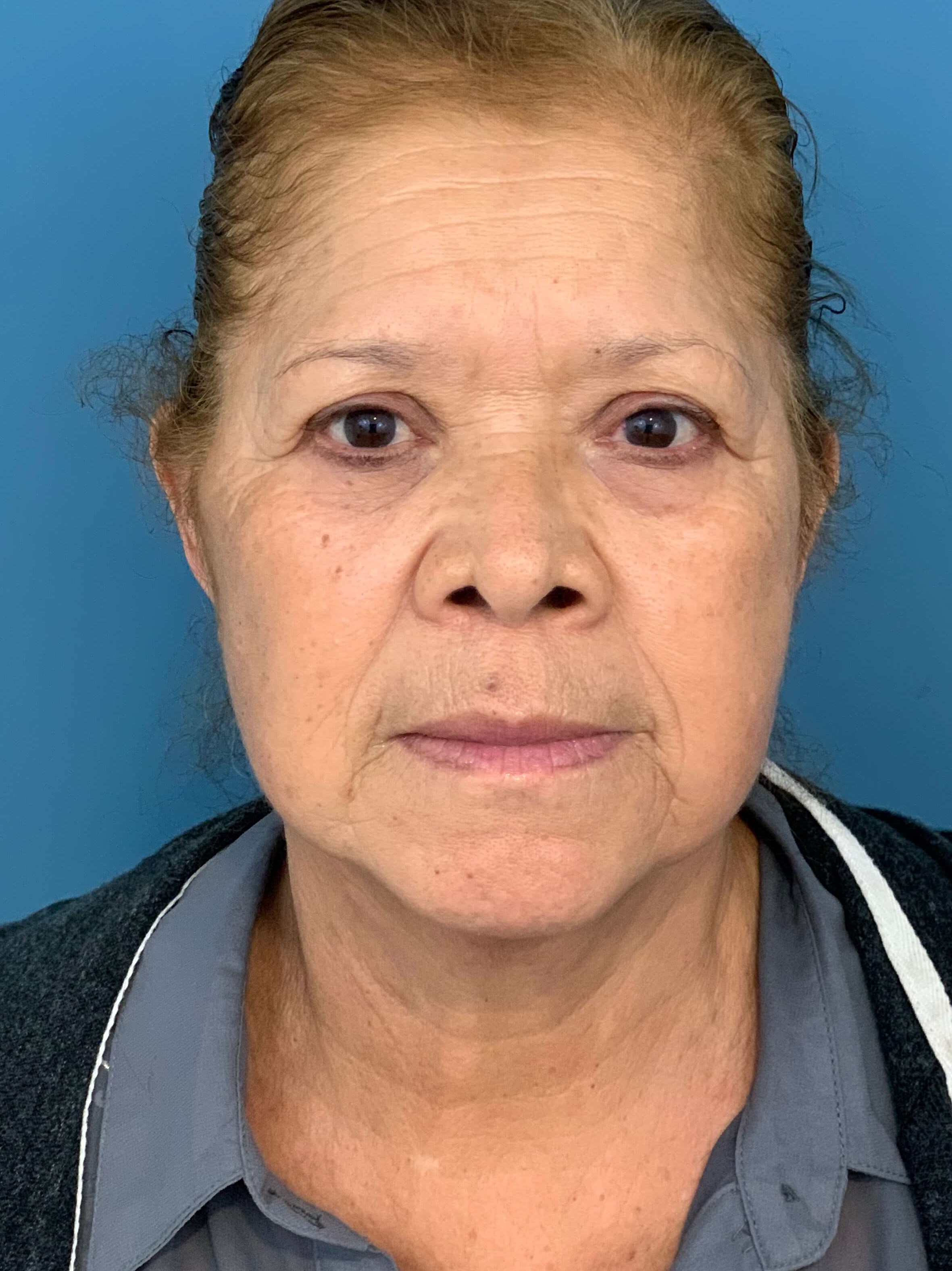 Facelift and Buccal Fat Removal in the Office — before, view 2
