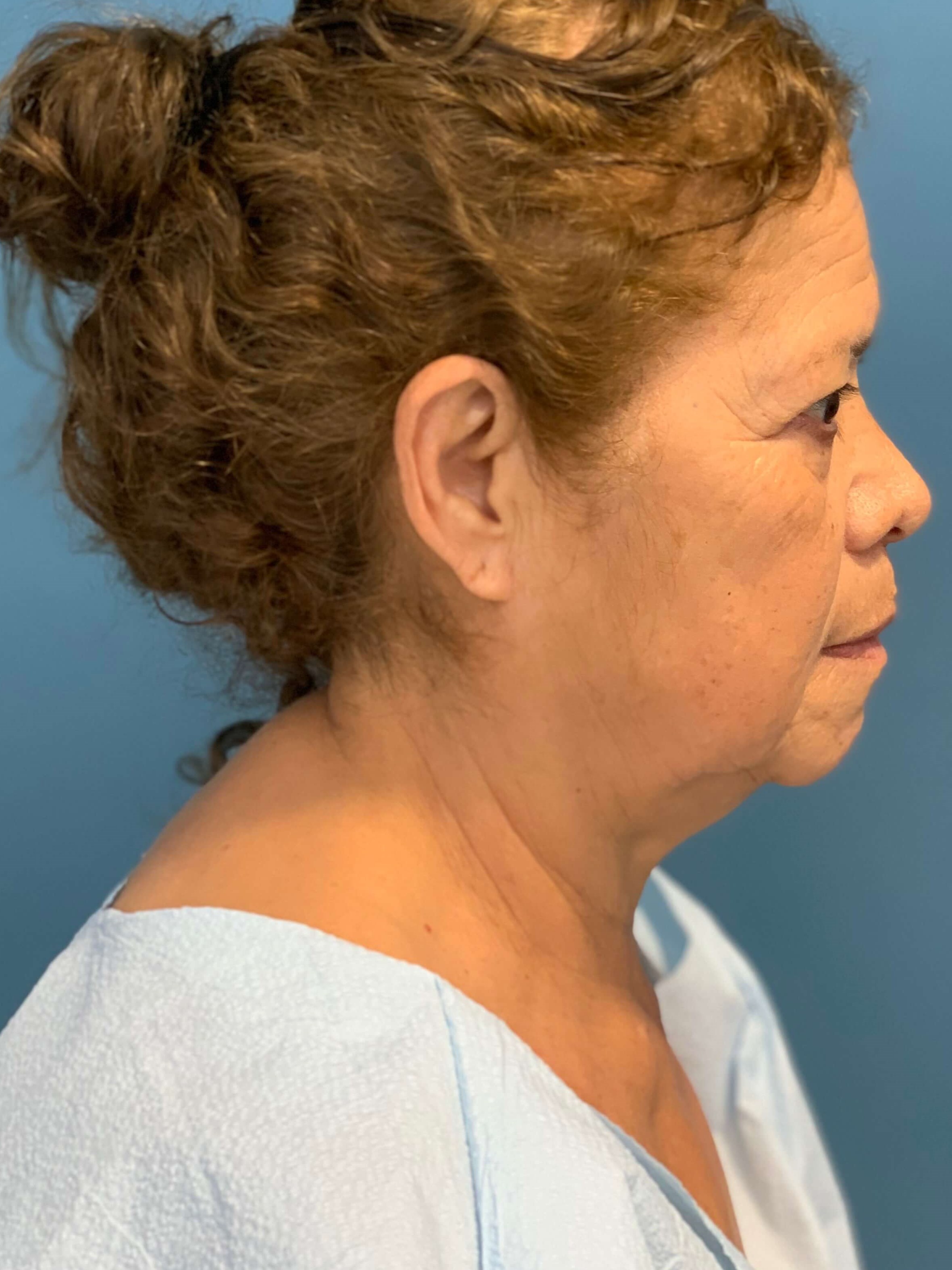 Facelift and Buccal Fat Removal in the Office — before, view 3