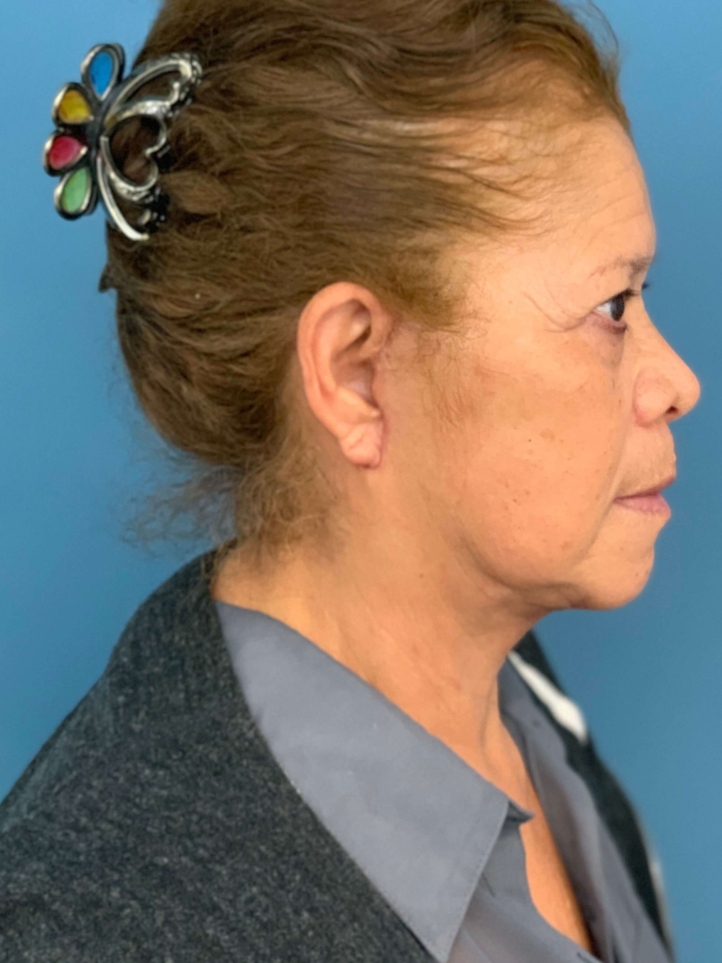 Facelift and Buccal Fat Removal in the Office — before, view 4