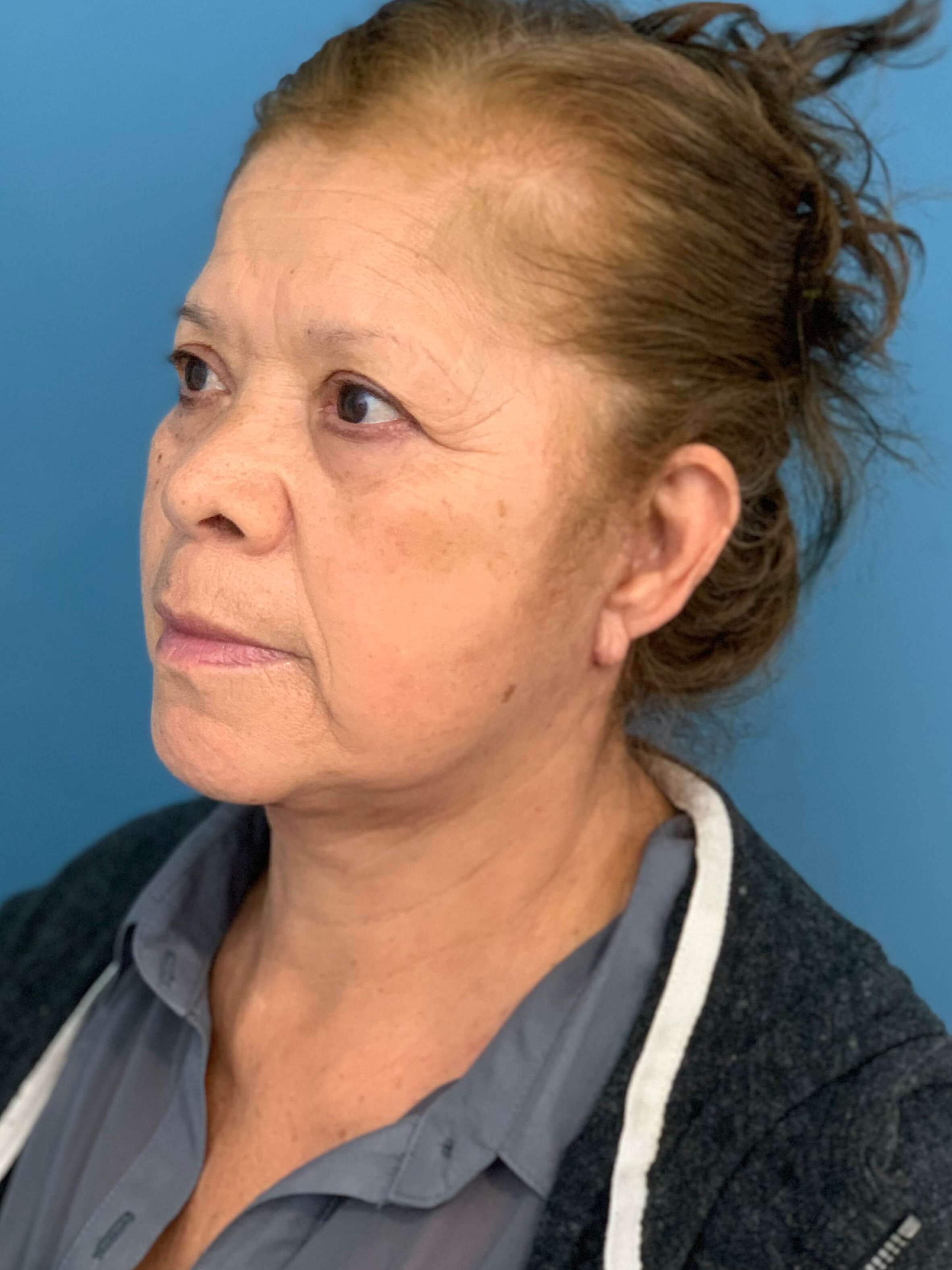 Facelift and Buccal Fat Removal in the Office