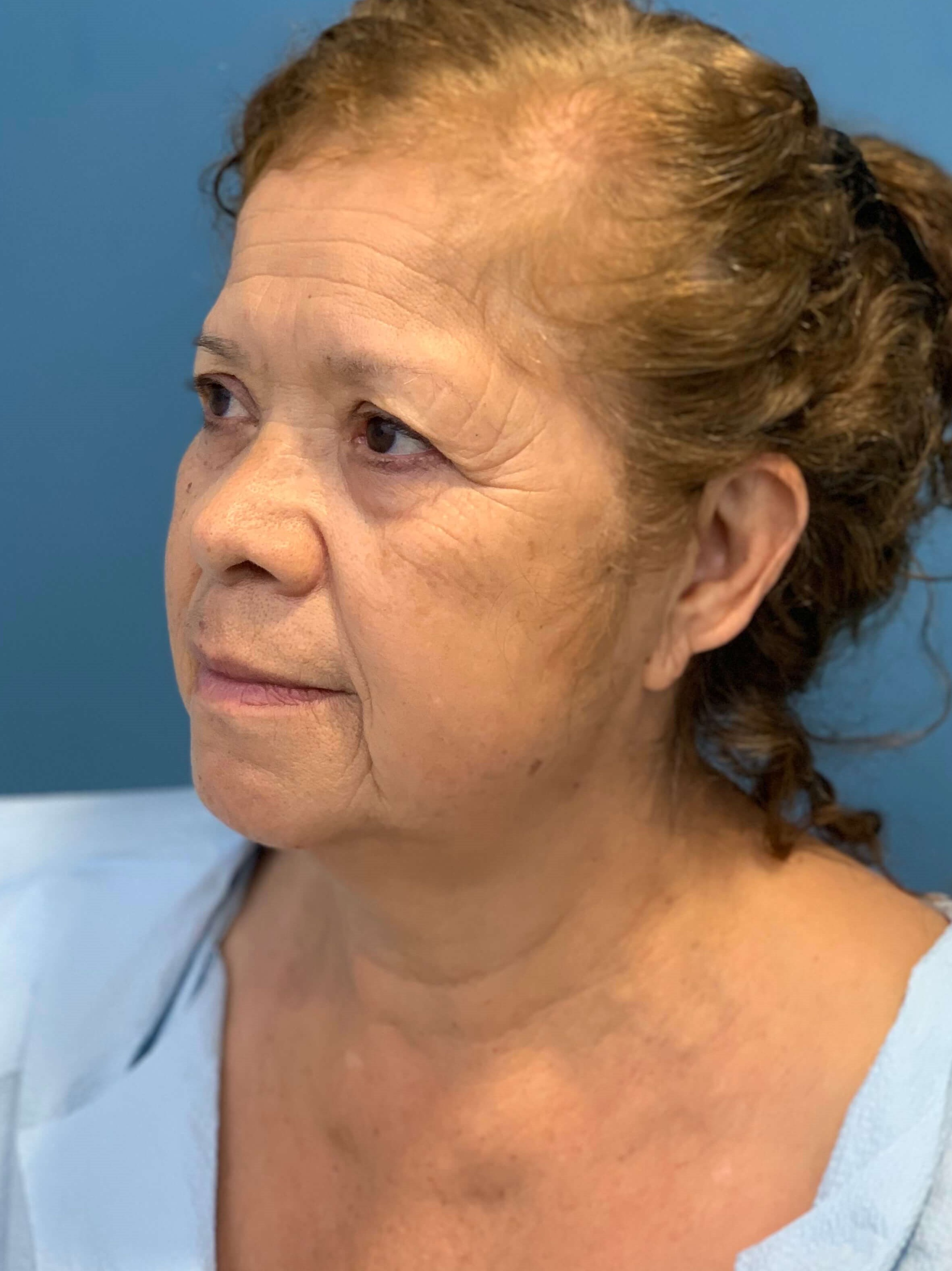 Facelift and Buccal Fat Removal in the Office — after, view 2