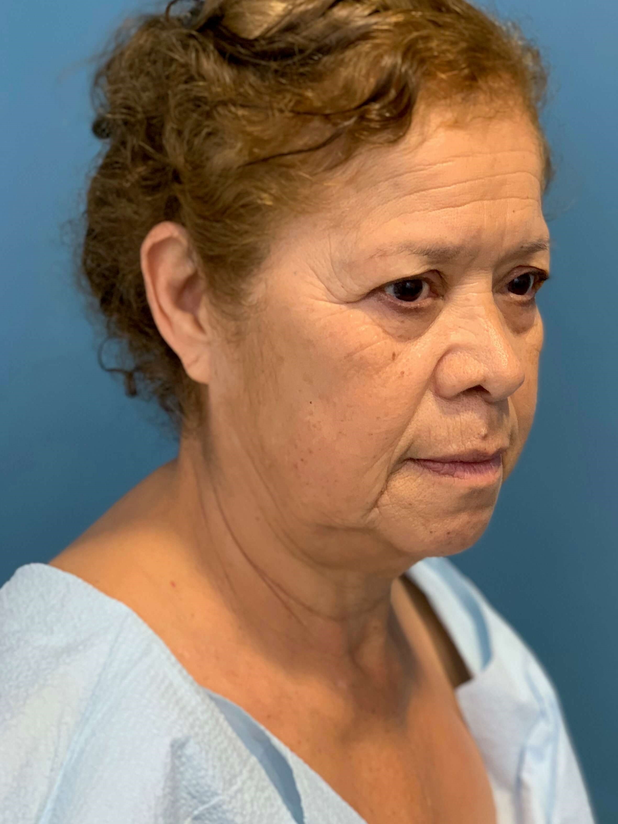 Facelift and Buccal Fat Removal in the Office — after, view 3
