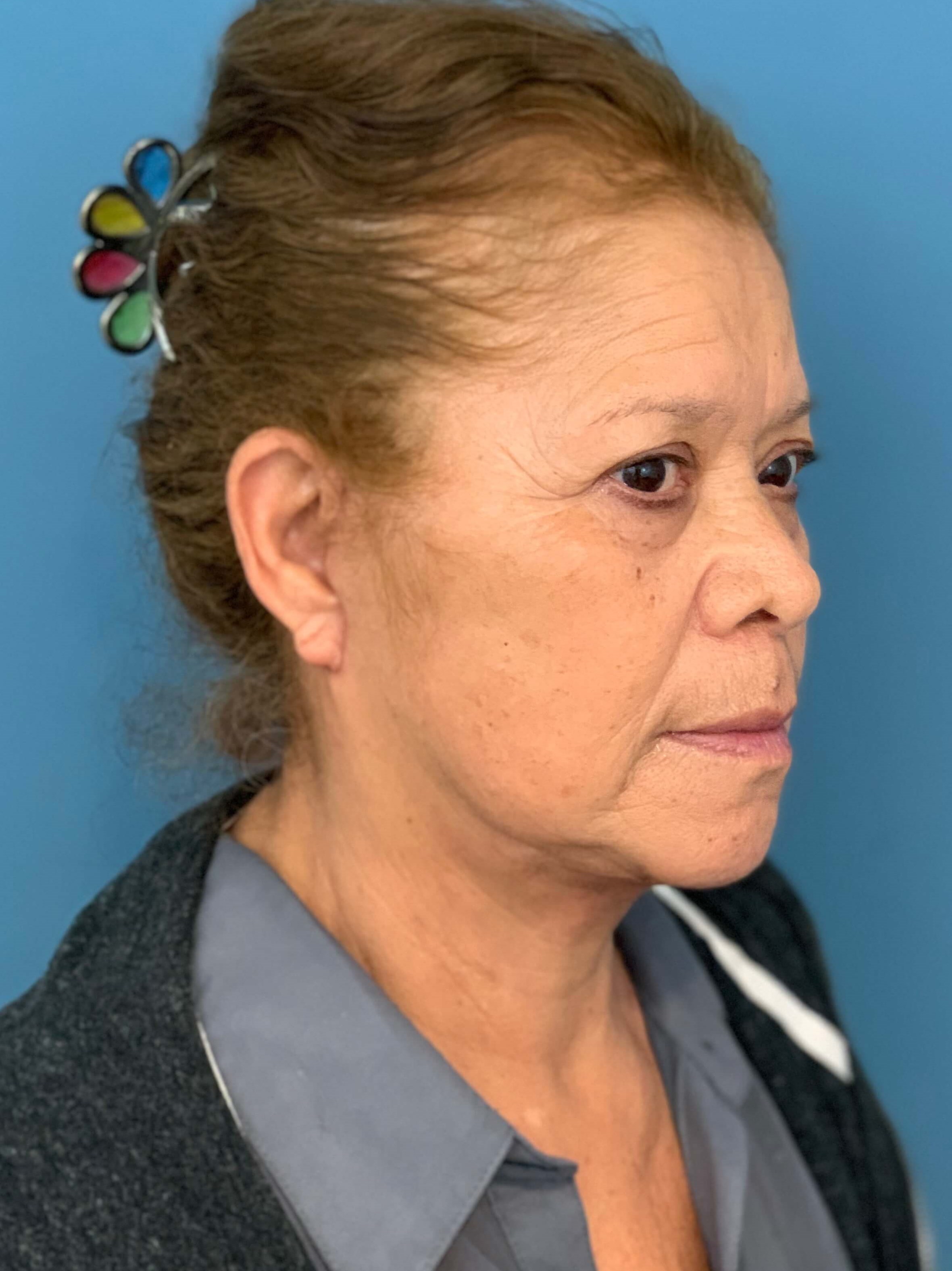 Facelift and Buccal Fat Removal in the Office — after, view 4