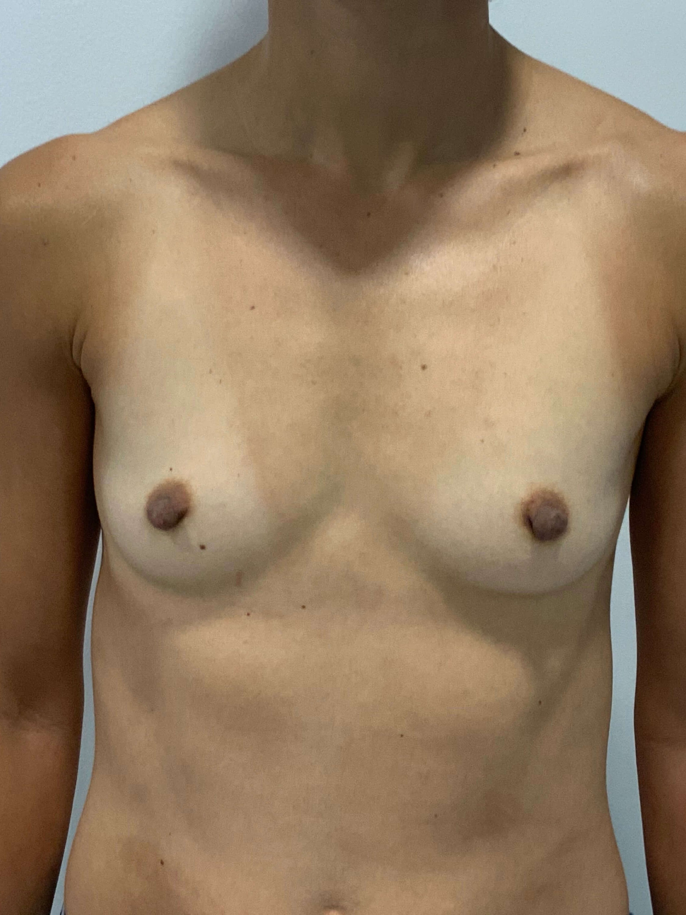 Sientra Smooth Round Moderate Plus Profile Silicone 195 Cc Implant — before, view 1