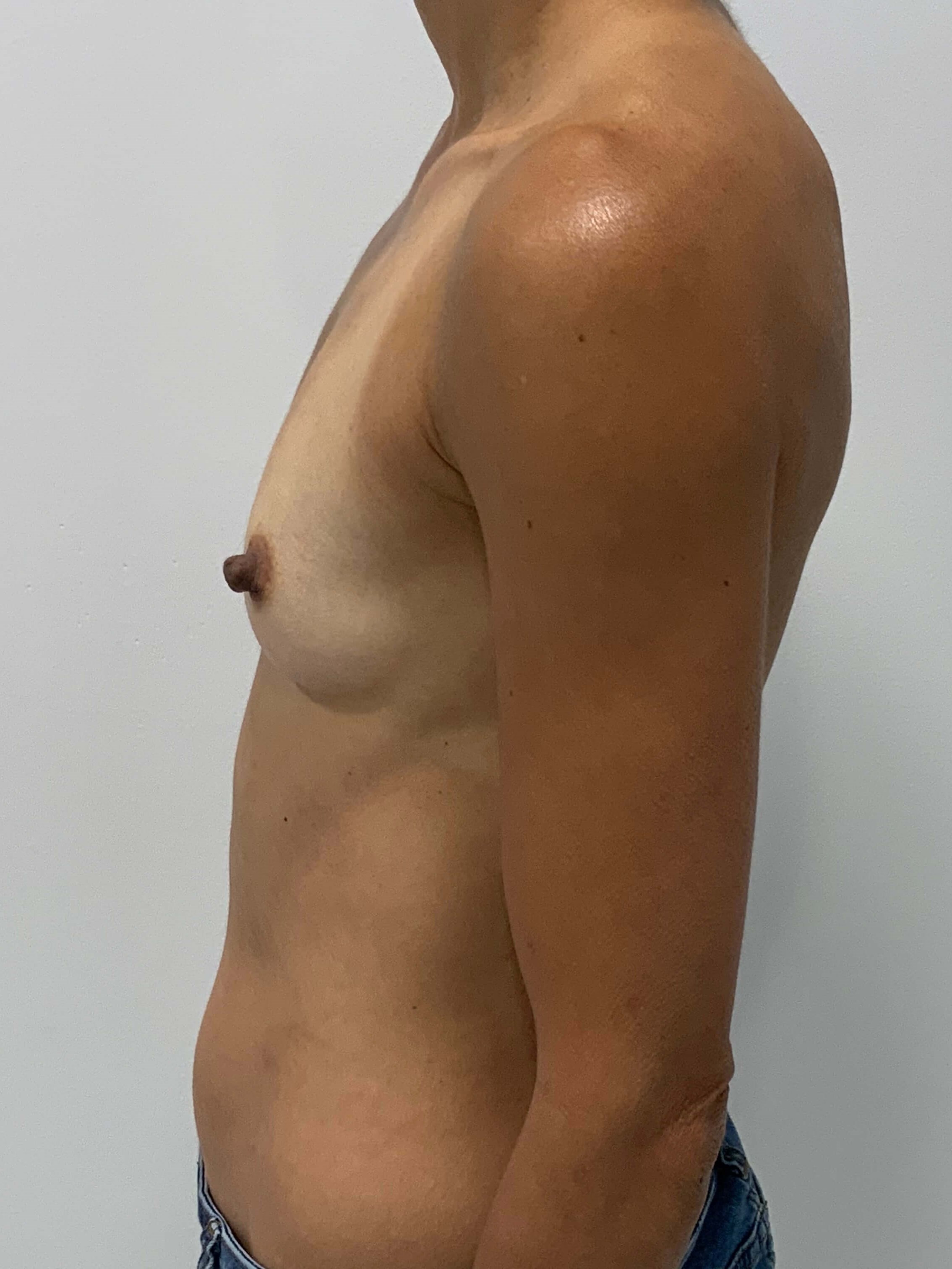 Sientra Smooth Round Moderate Plus Profile Silicone 195 Cc Implant — before, view 2