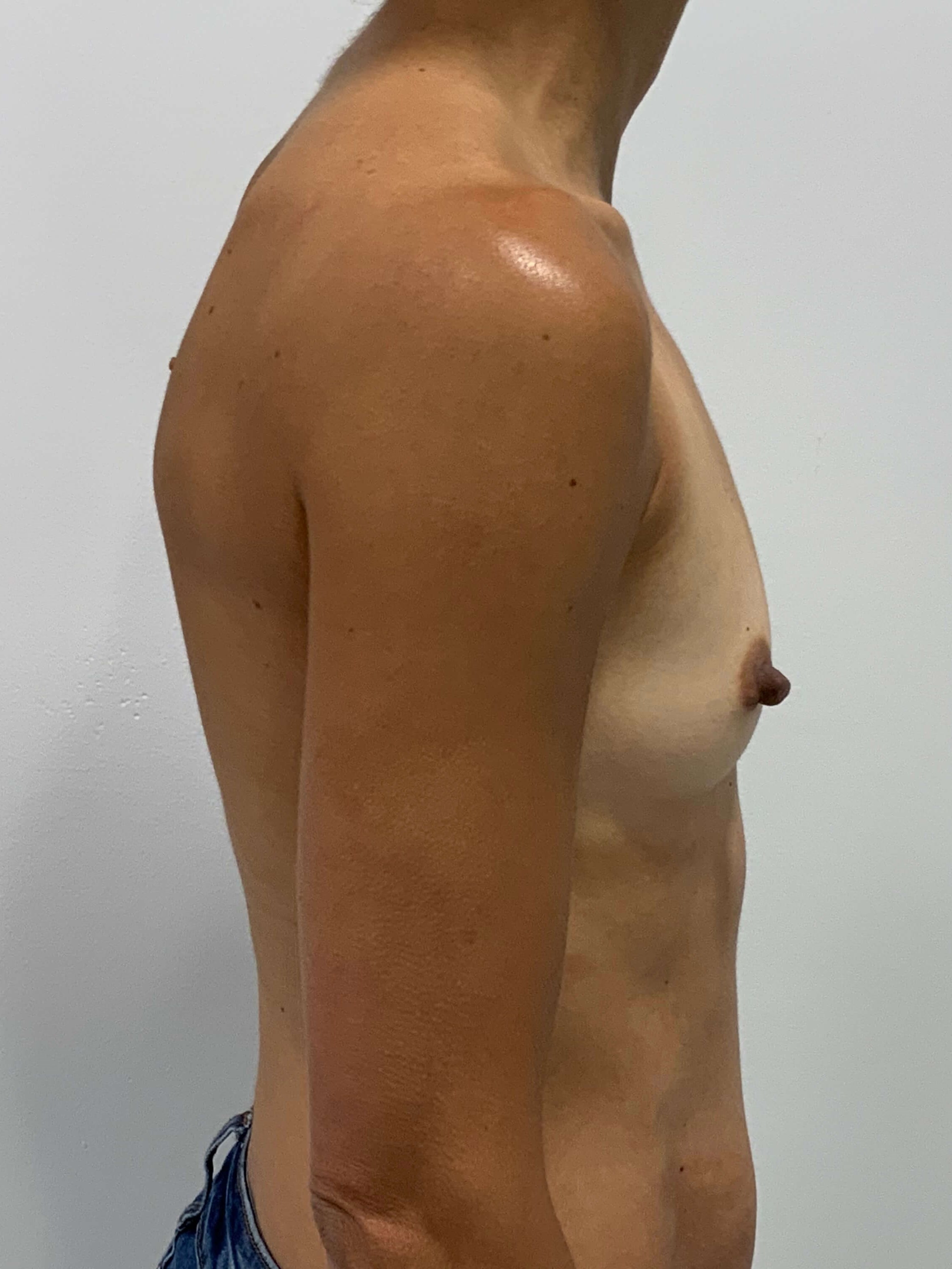 Sientra Smooth Round Moderate Plus Profile Silicone 195 Cc Implant — before, view 3