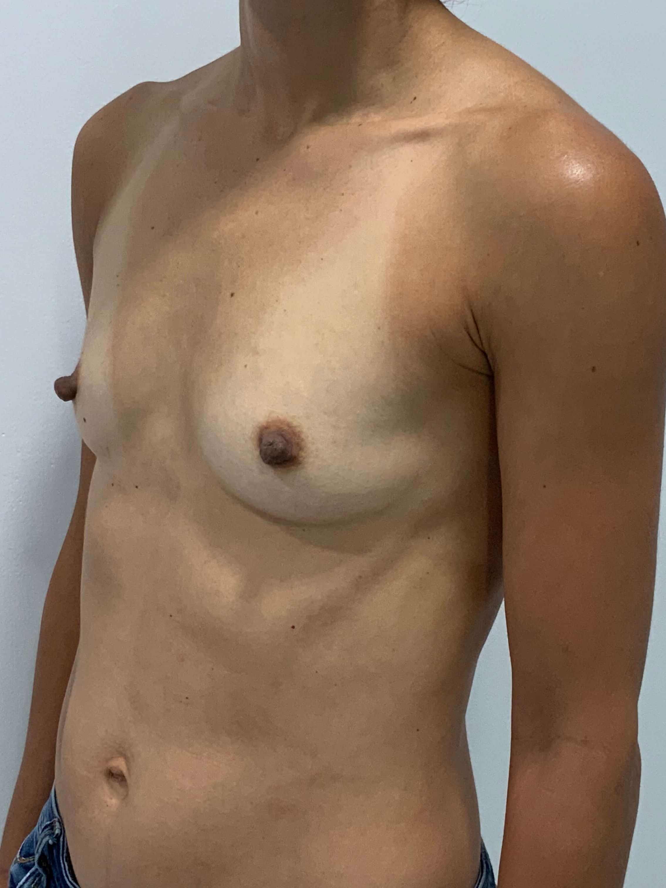 Sientra Smooth Round Moderate Plus Profile Silicone 195 Cc Implant — before, view 4