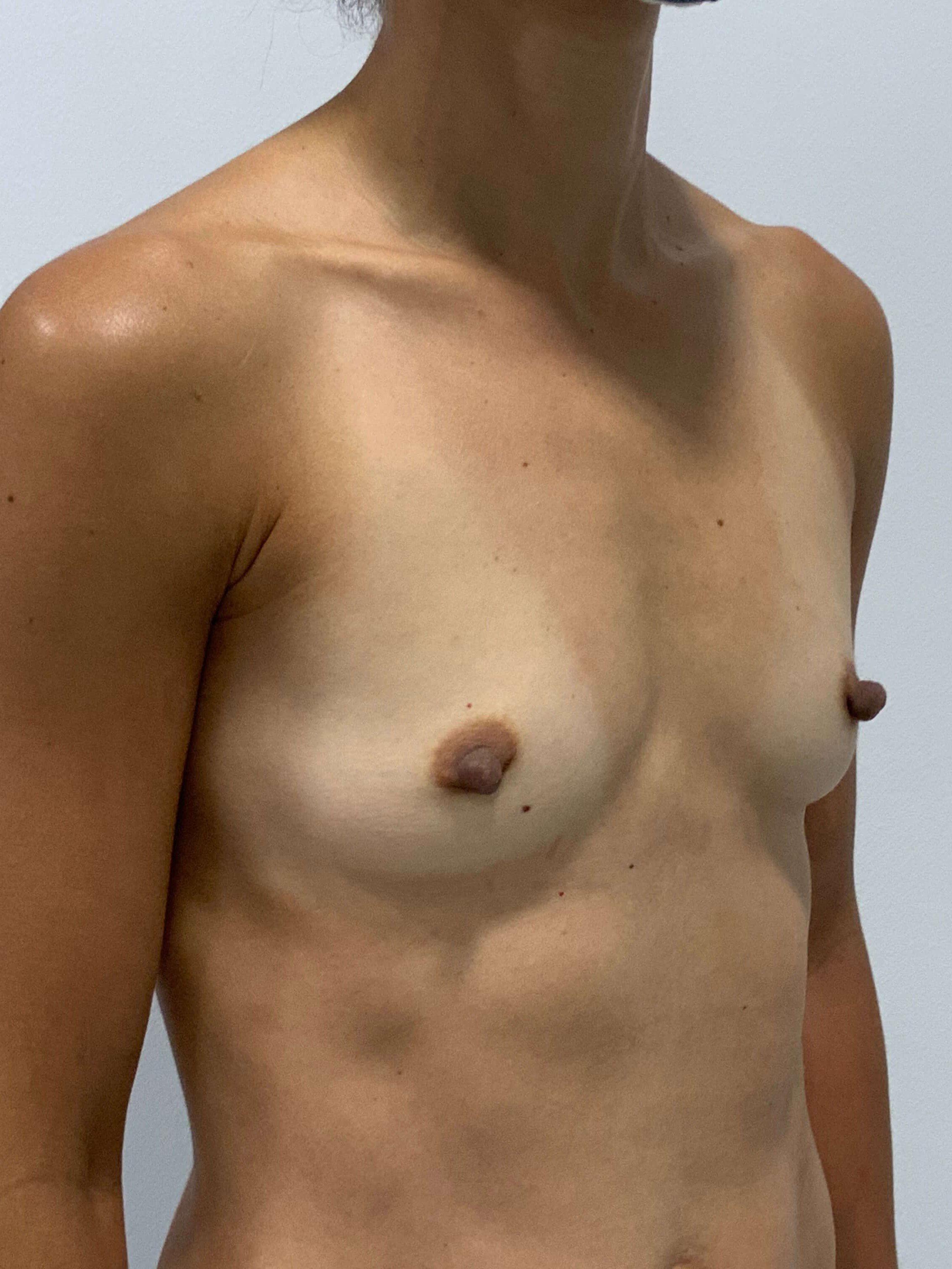 Sientra Smooth Round Moderate Plus Profile Silicone 195 Cc Implant — before, view 5