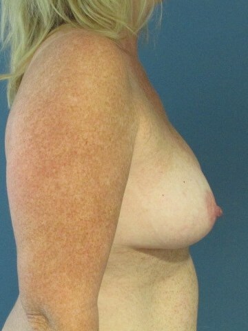 Breast Augmentation in Forty-Four Year-Old Woman — before, view 5
