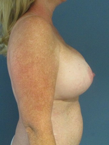 Breast Augmentation in Forty-Four Year-Old Woman — after, view 5