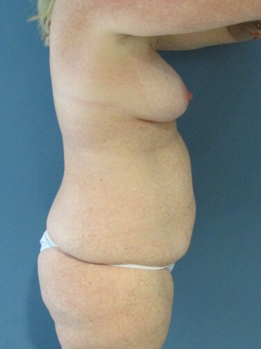 Mini Tummy Tuck and Liposuction — before, view 2