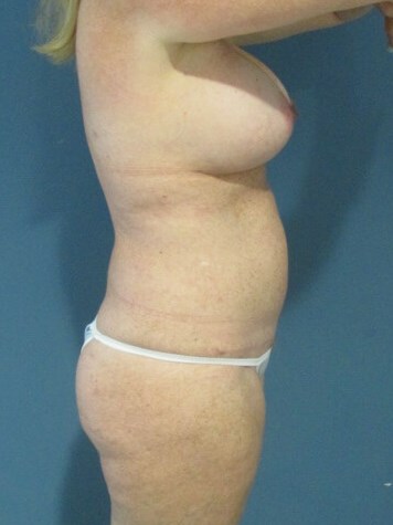 Mini Tummy Tuck and Liposuction — after, view 2
