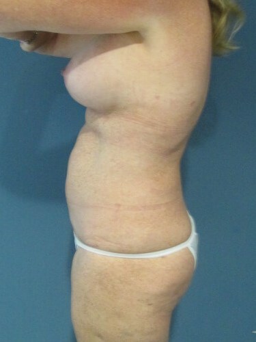 Mini Tummy Tuck and Liposuction — after, view 3