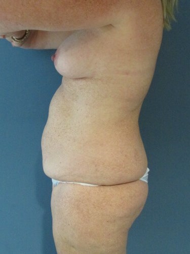 Mini Tummy Tuck and Liposuction — before, view 3