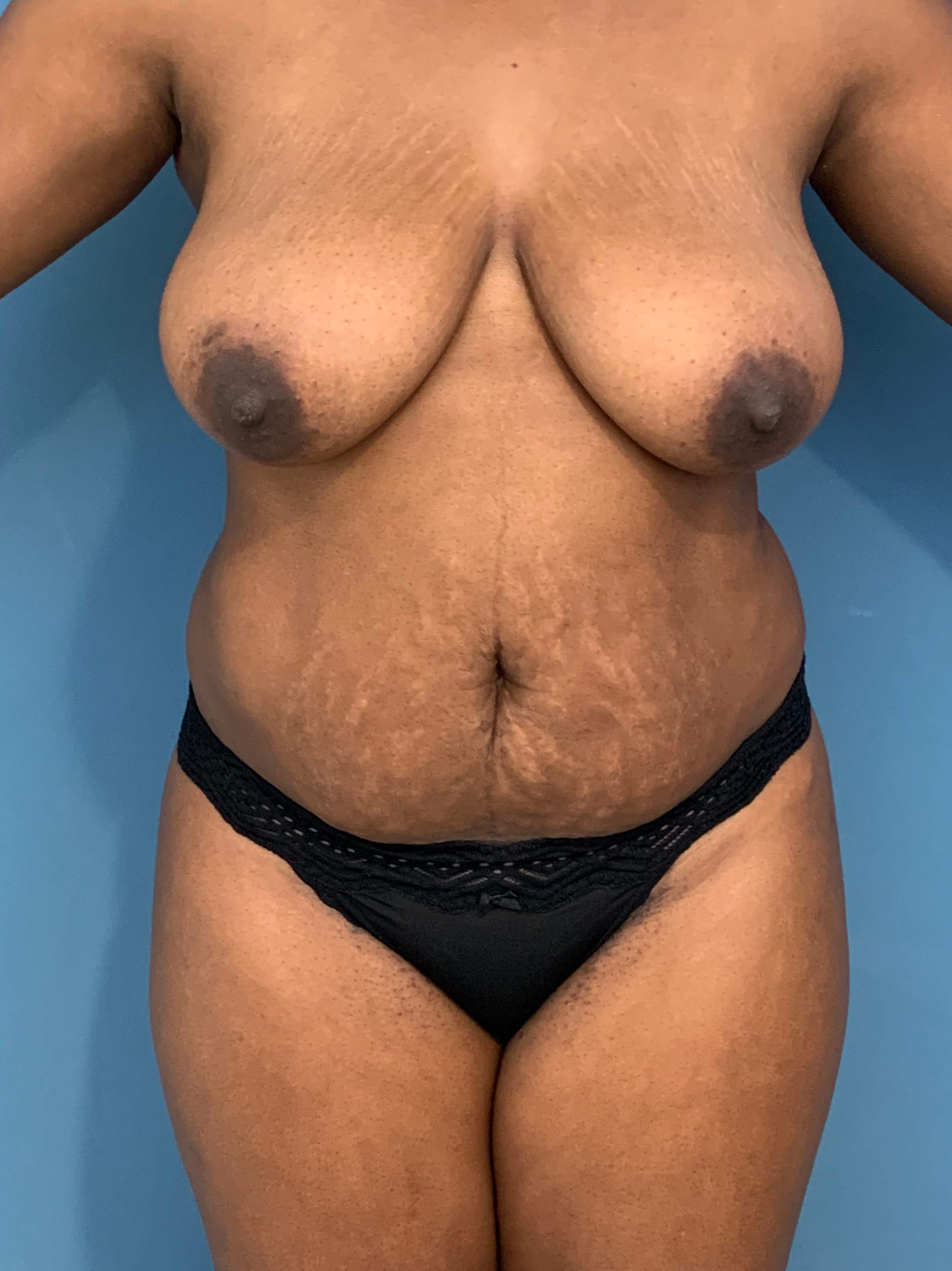 Full Abdominoplasty with Deep Muscle Plication and Liposuction of Bilateral Flanks, before, view 1