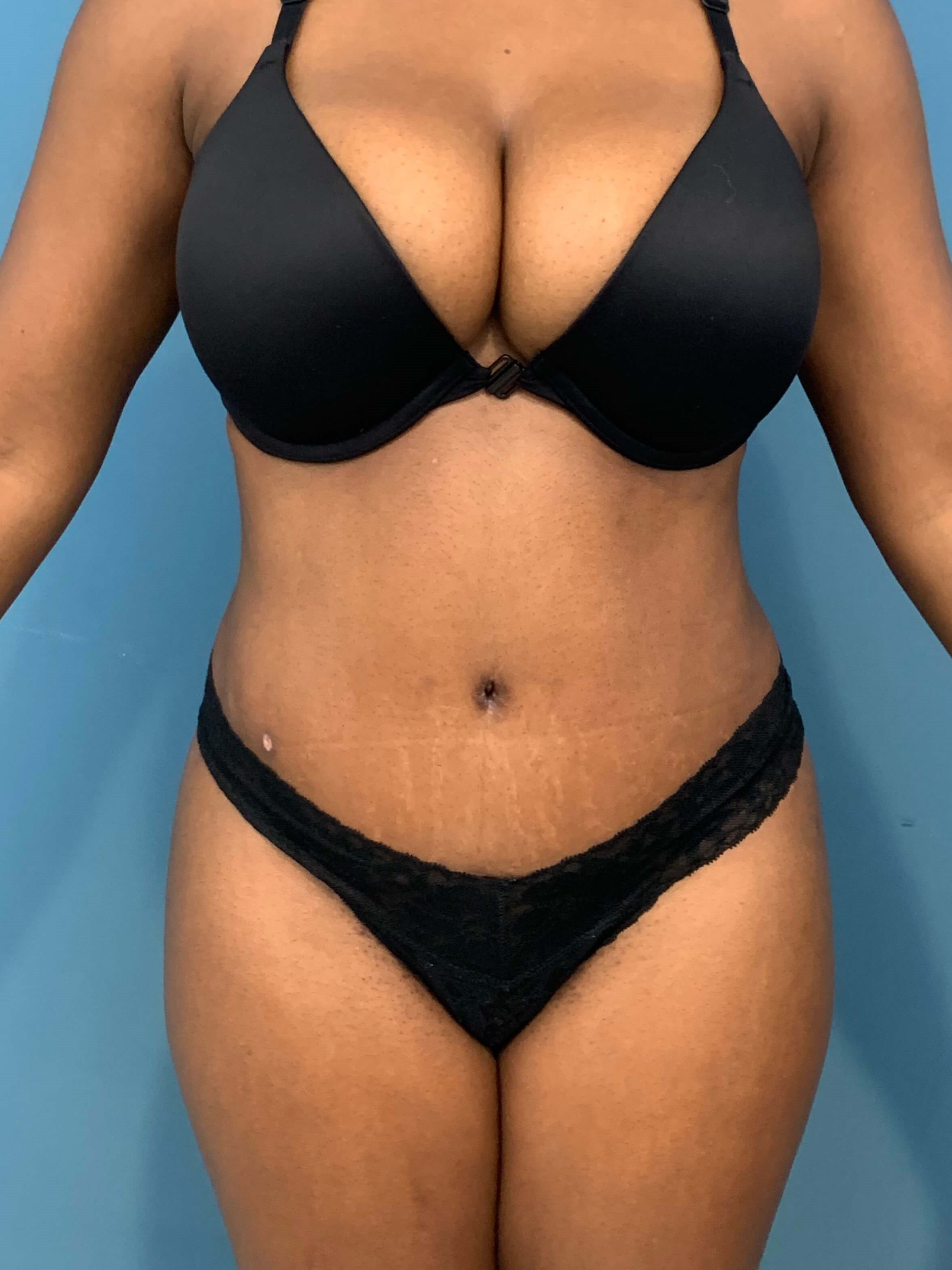 Full Abdominoplasty with Deep Muscle Plication and Liposuction of Bilateral Flanks, after, view 1