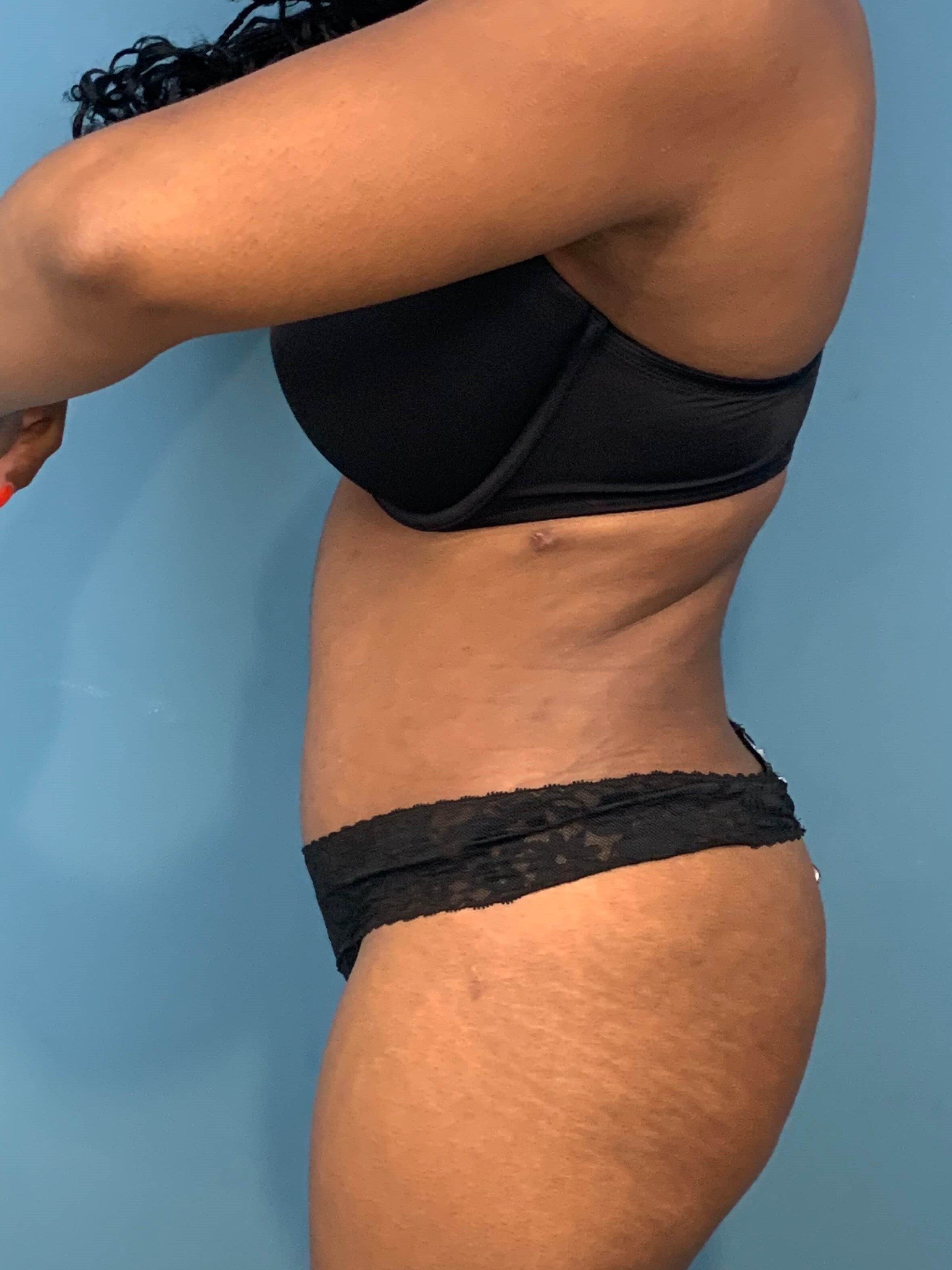 Full Abdominoplasty with Deep Muscle Plication and Liposuction of Bilateral Flanks, after, view 2